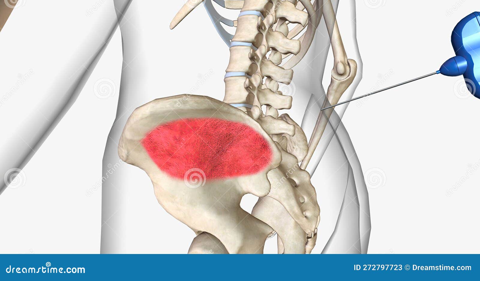 Bone Marrow Aspiration is a Procedure in Which a Liquid Bone Marrow