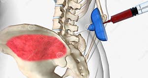 Bone Marrow Aspiration Is A Procedure In Which A Liquid Bone Marrow 