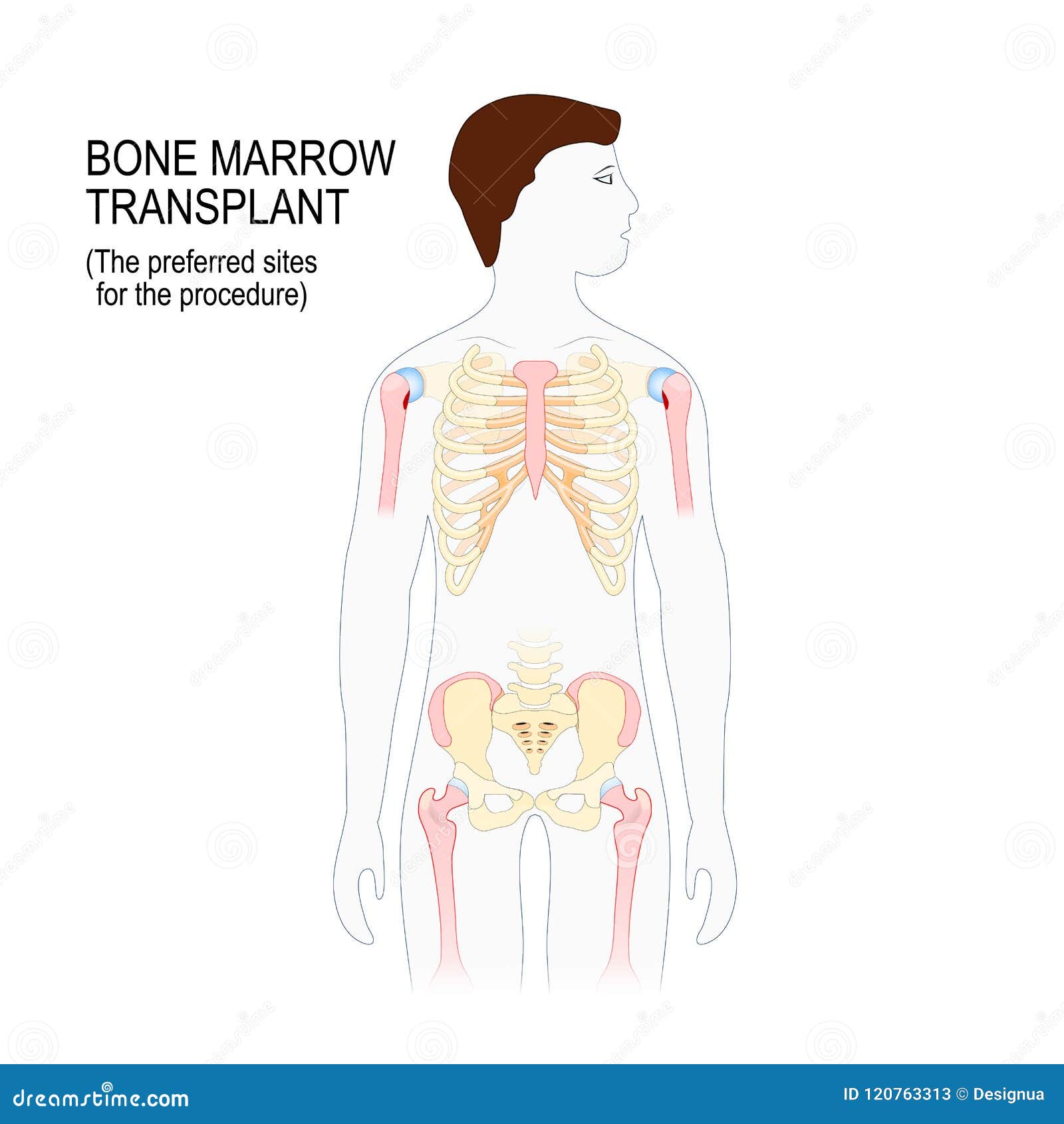 bone marrow transplant. the preferred sites for the transplantation procedure