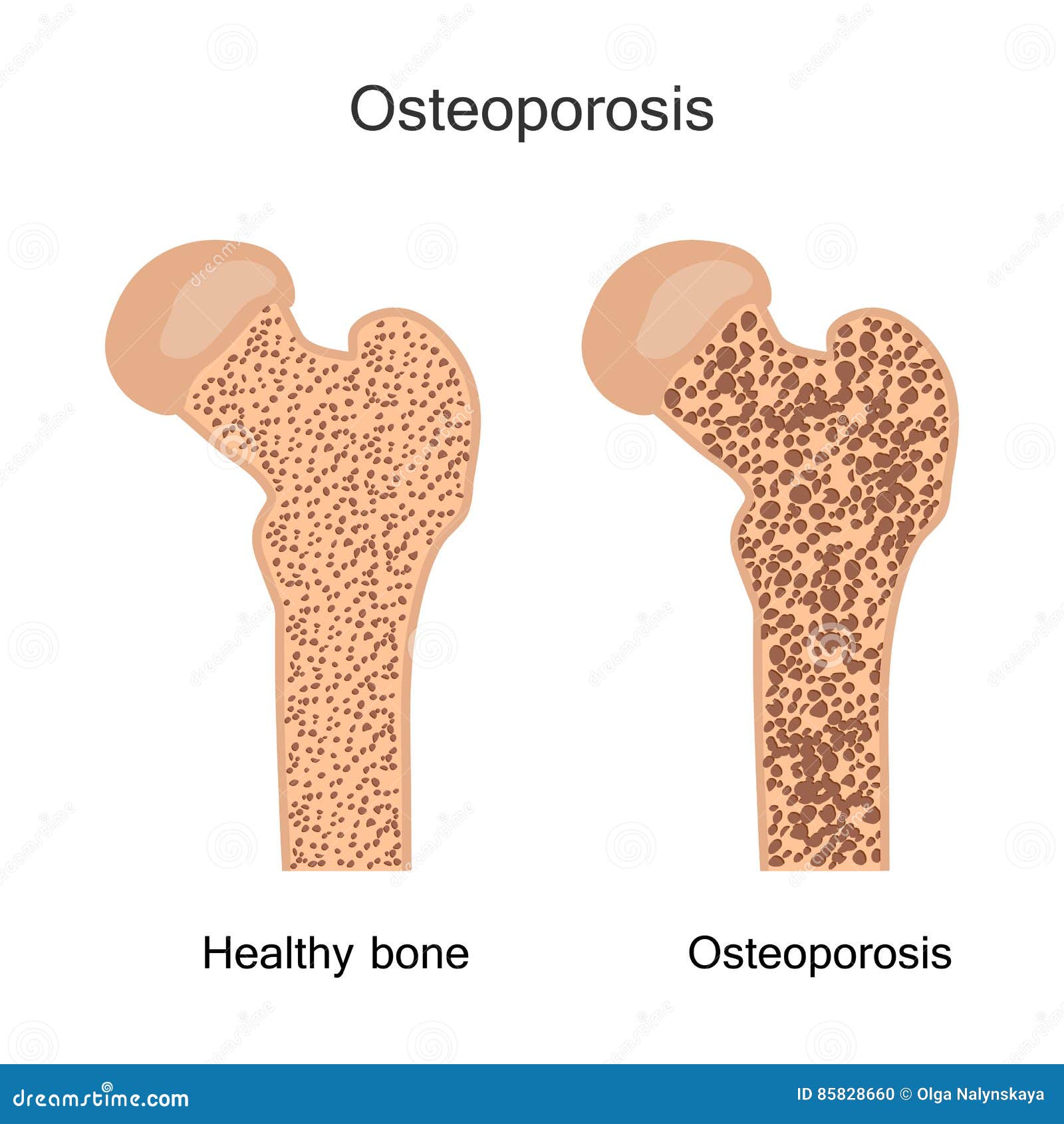Bone Osteoporosis Illustration Stock Vector Illustration of human