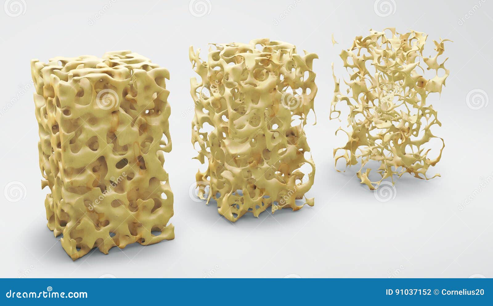 bone structure normal and with osteoporosis