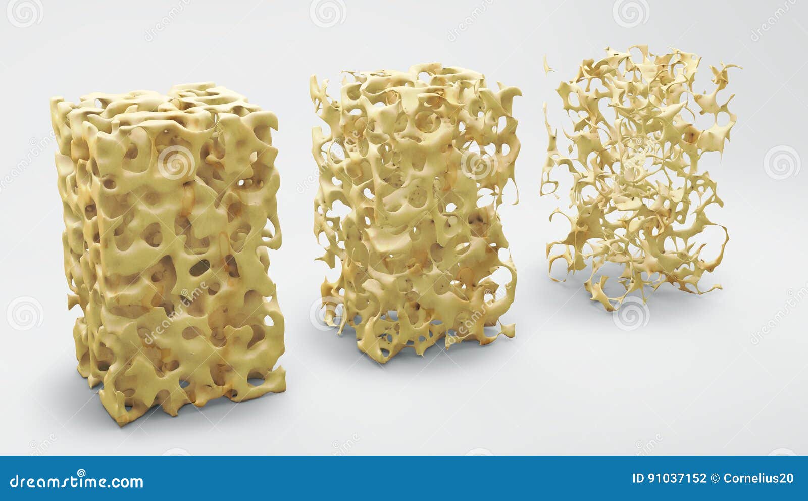 Bone Structure Normal and with Osteoporosis Stock Illustration Biology Diagrams