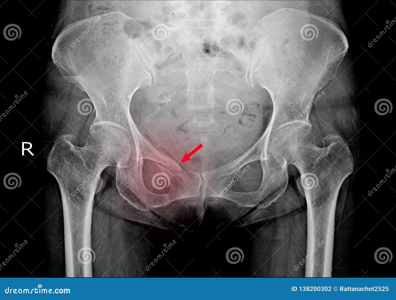 hip x-ray fracture right superior pubic ramus.normal both hips