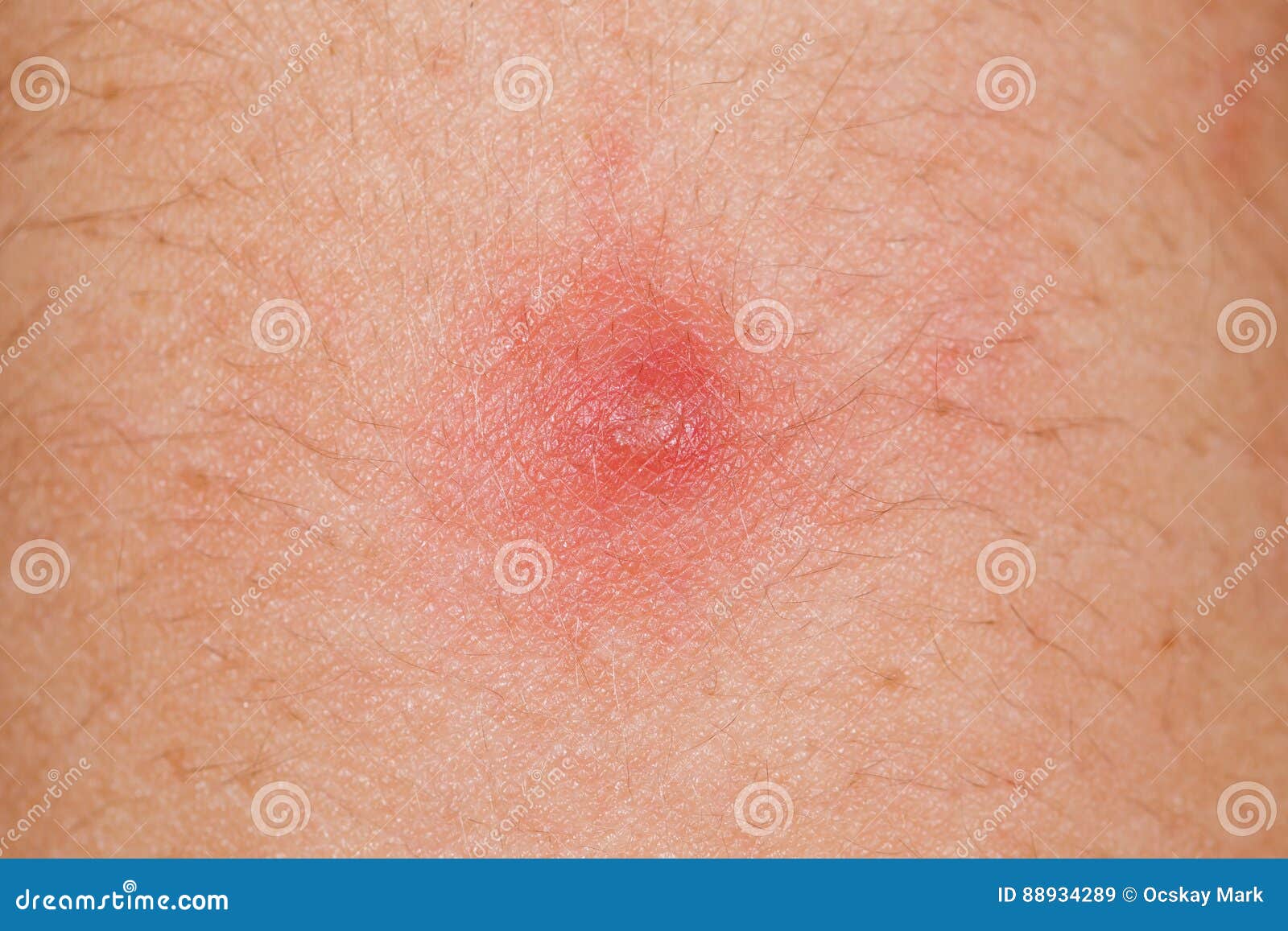 Bouton Rouge Sur La Peau Humaine Image stock - Image du infecté, infection:  88934289