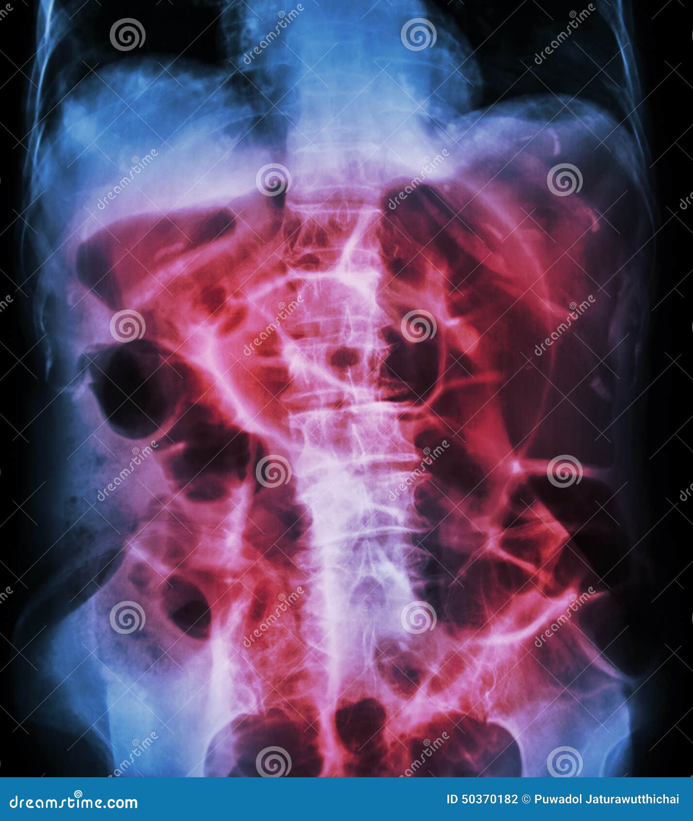 bowel obstruction ( x-ray abdomen supine position : large bowel