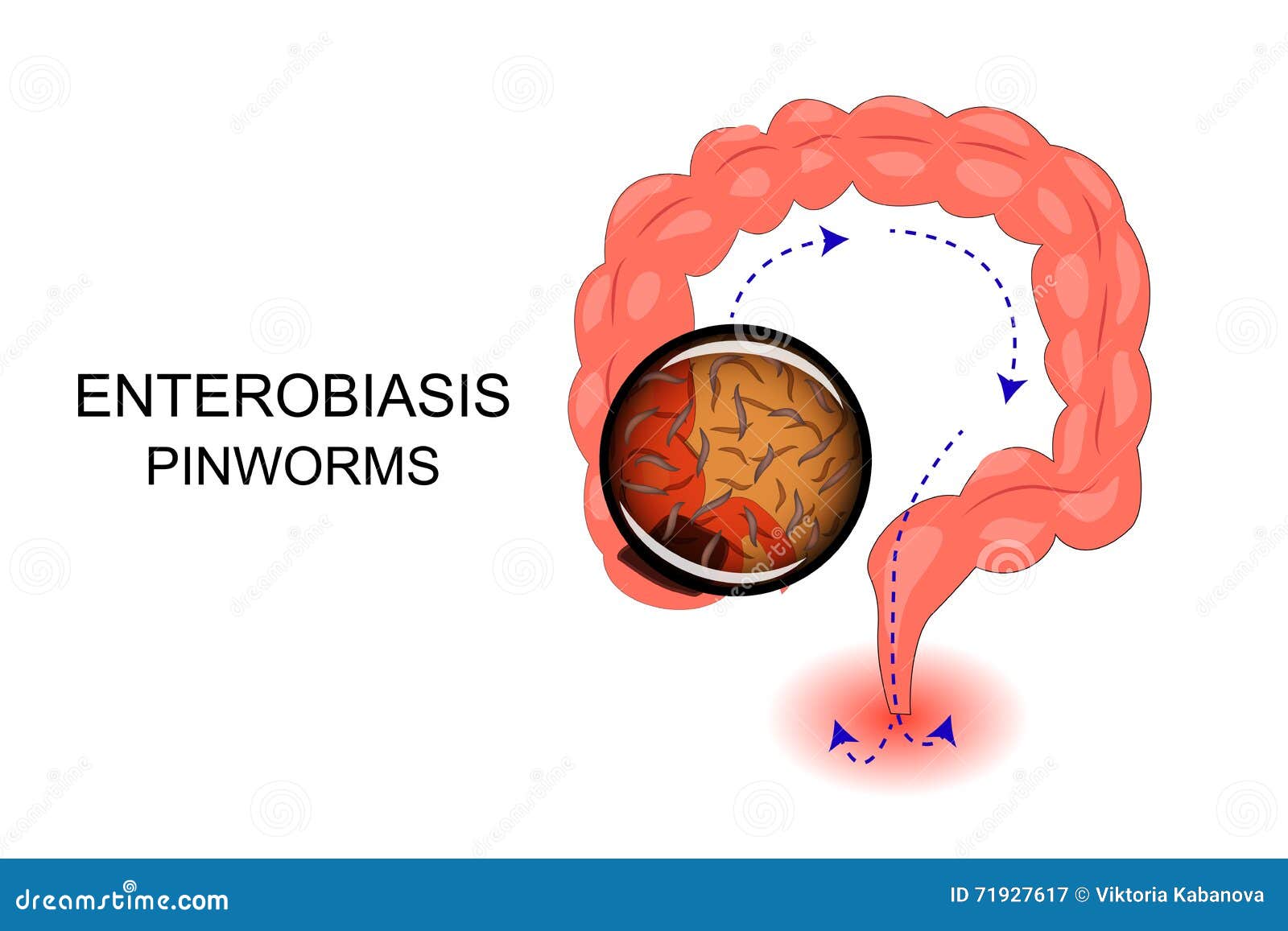 mi a veszélyes enterobiosis