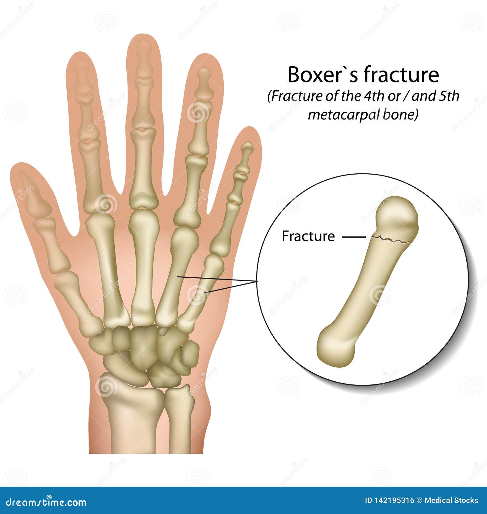 boxer`s bone hand fracture medical  