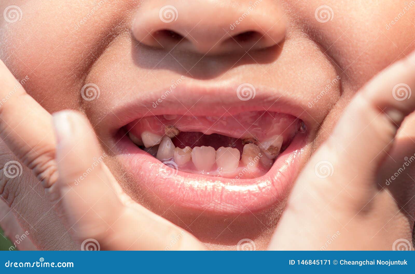 The Boy with Decayed Baby Teeth Stock Image Image of little
