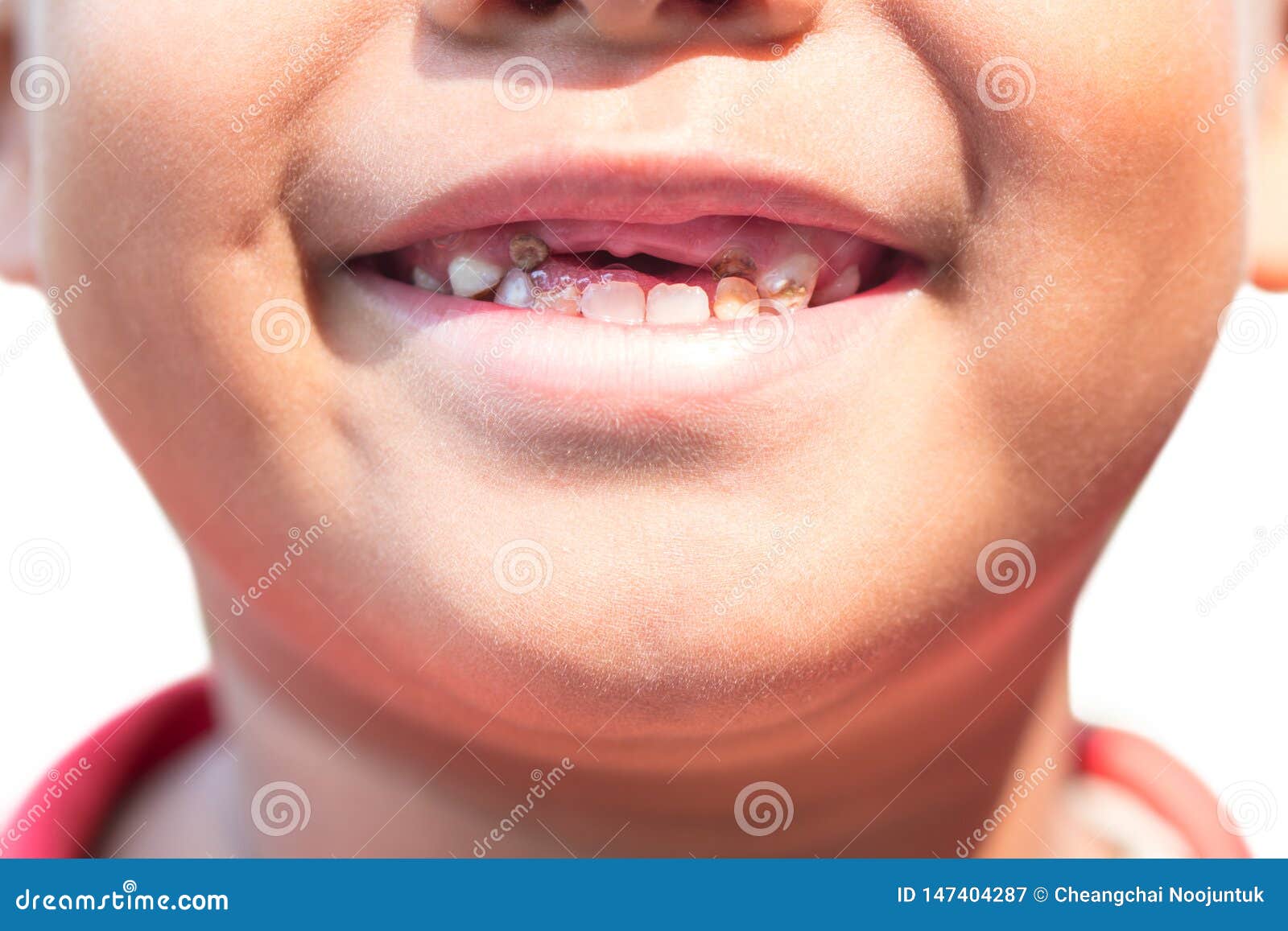 The Boy with Decayed Baby Teeth. Stock Image Image of milk, dental