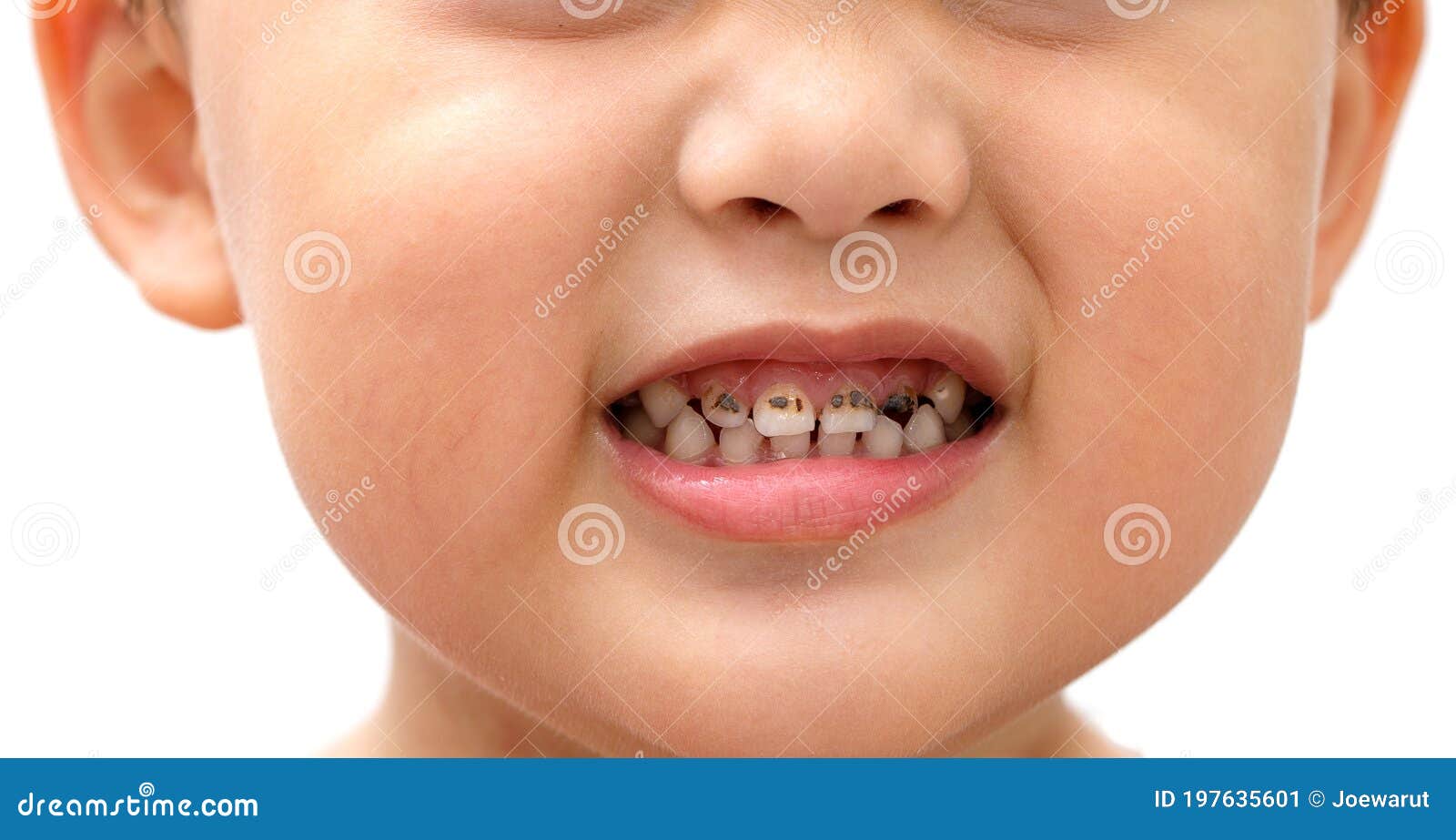 boy showing tooth decay