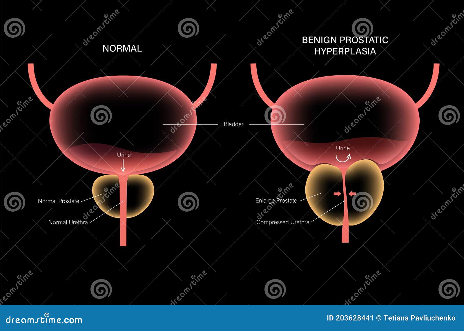 BPH info concept stock illustration. Illustration of enlargement 203628441
