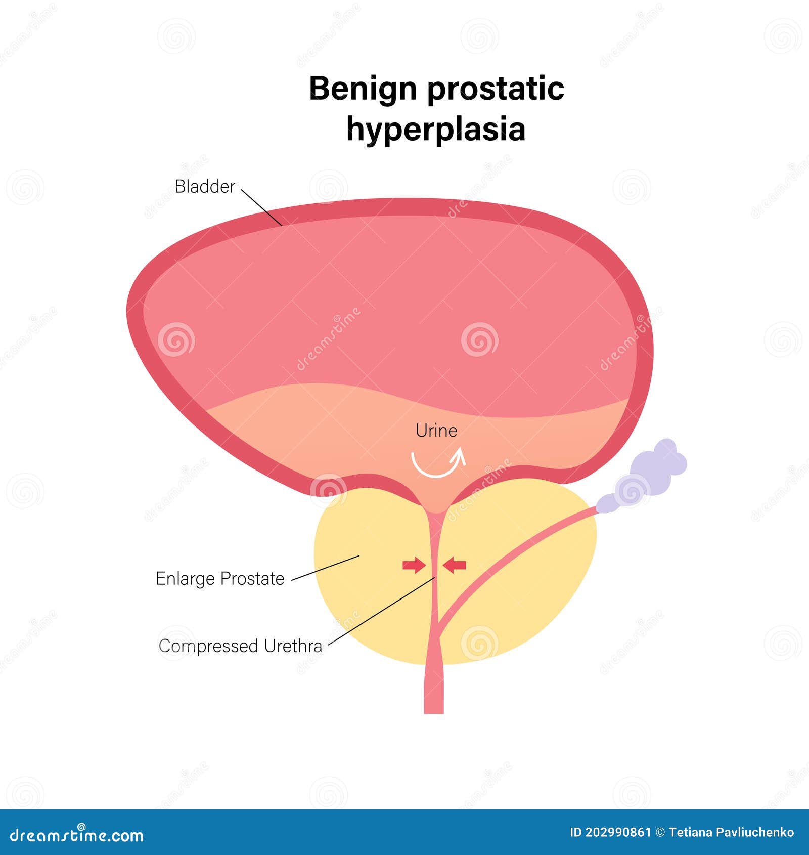 benign prostatic hyperplasia infertility mi az echo krónikus prosztatitis
