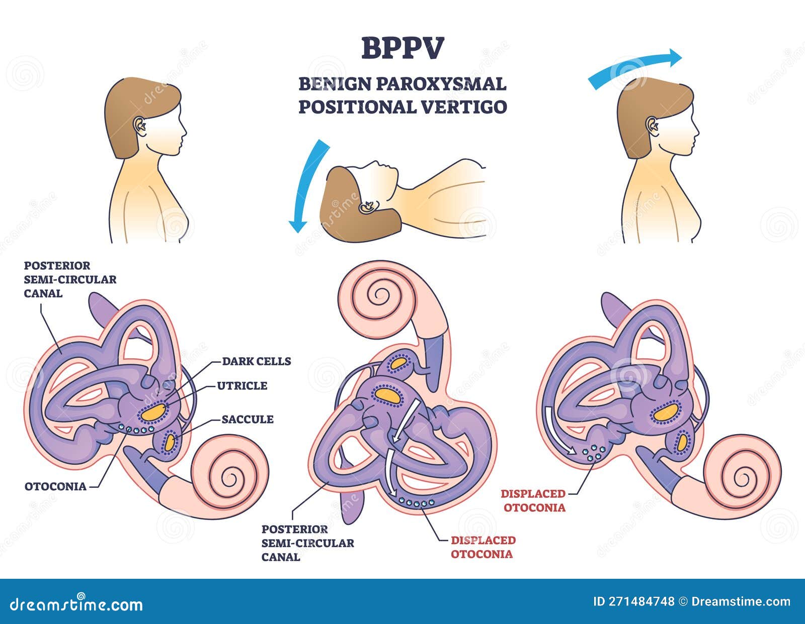 bppv or benign paroxysmal positional vertigo syndrome outline diagram