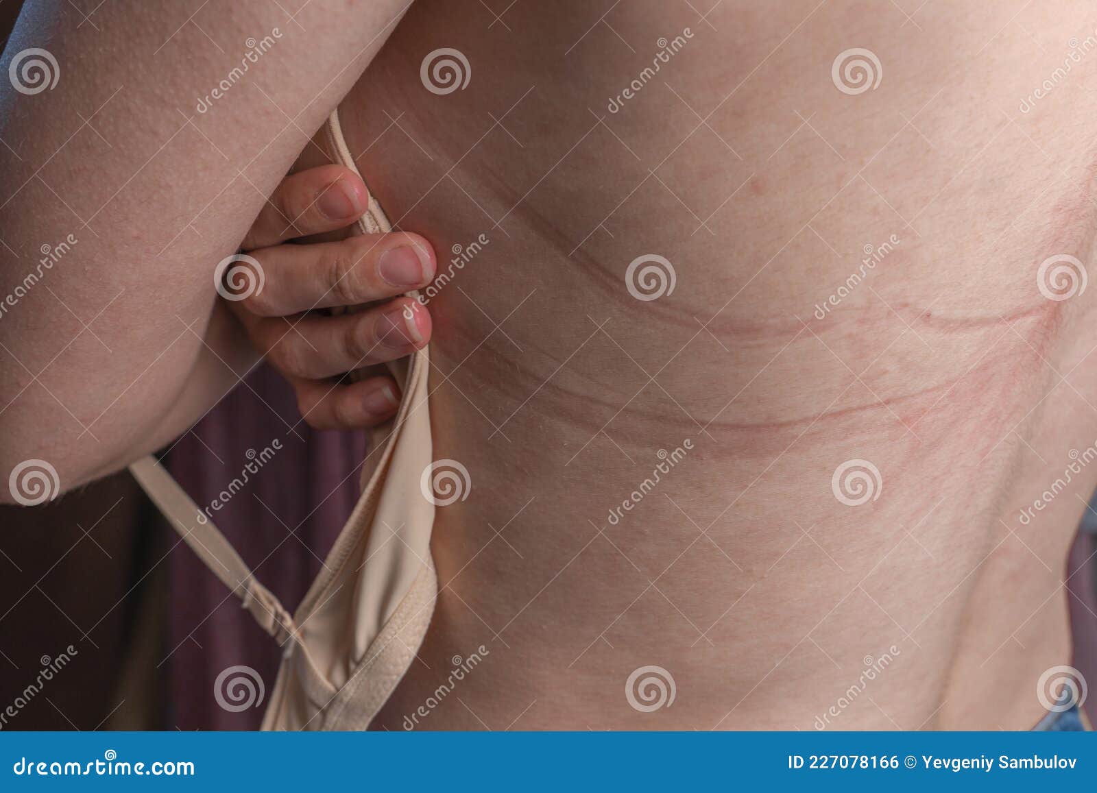 Bra Marks on the Back. the Girl Rubbed Her Back with Her Underwear.  Uncomfortable Bra. the Wrong Size Underwear Stock Photo - Image of mood,  human: 227078166