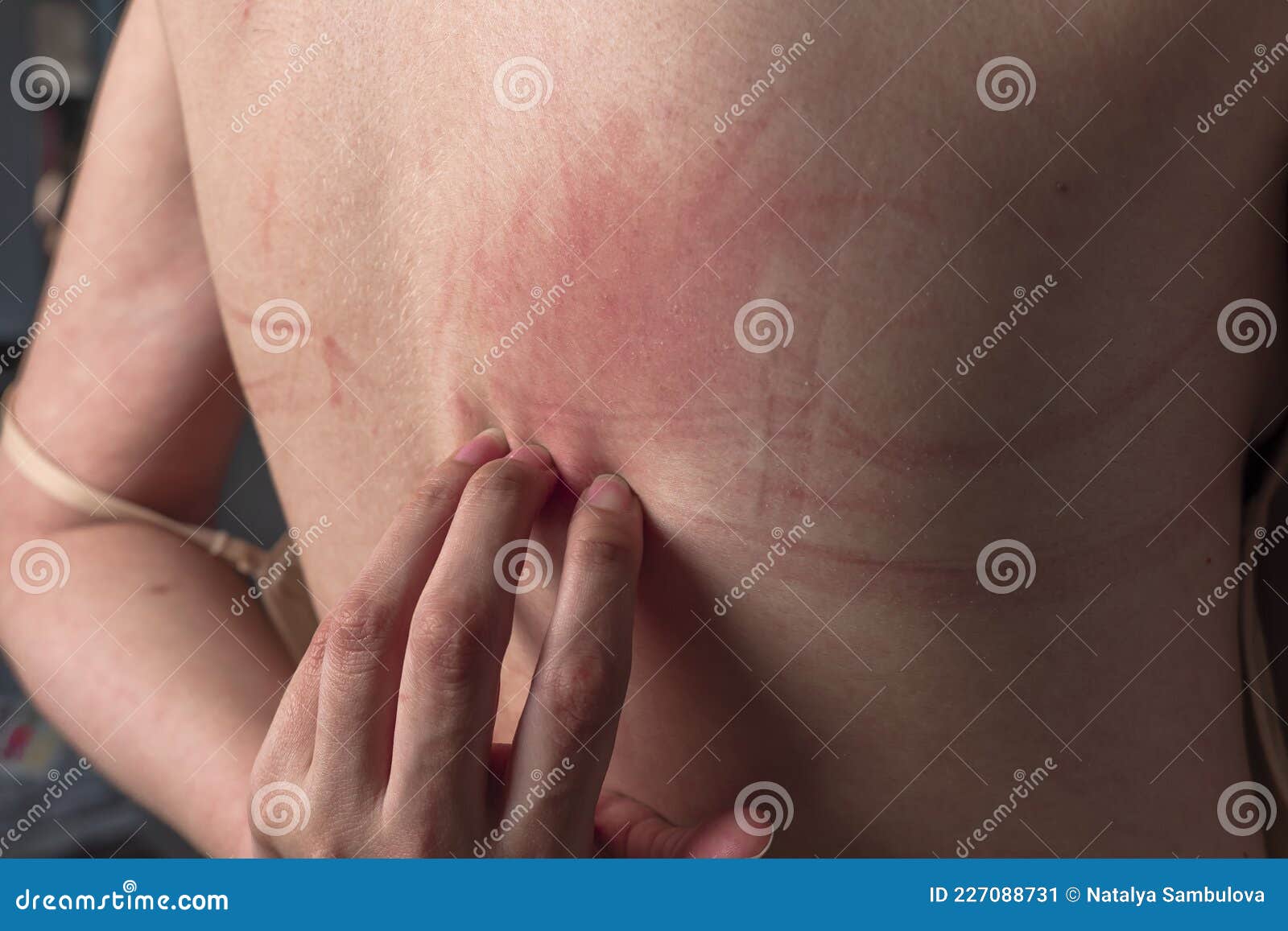 Bra Marks on the Back. the Girl Rubbed Her Back with Her Underwear.  Uncomfortable Bra. the Wrong Size Underwear Stock Image - Image of breast,  figure: 227088731