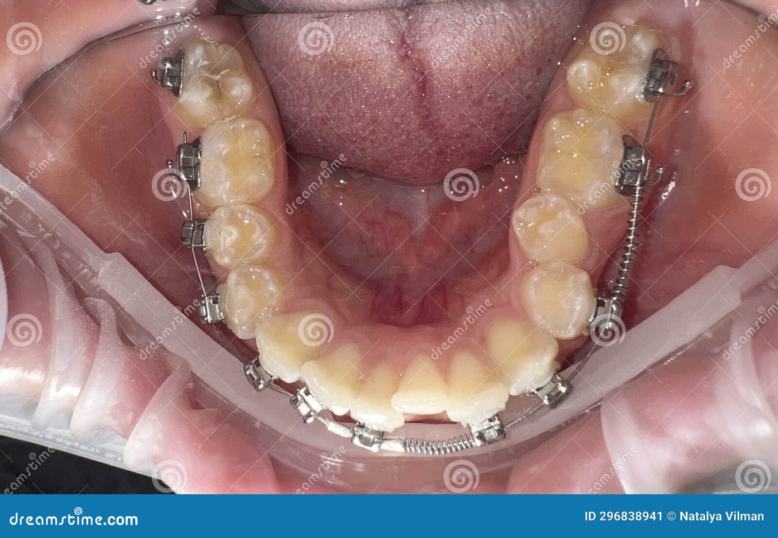 Braces on Teeth Closeup. Treatment of Crooked Teeth and Malocclusion