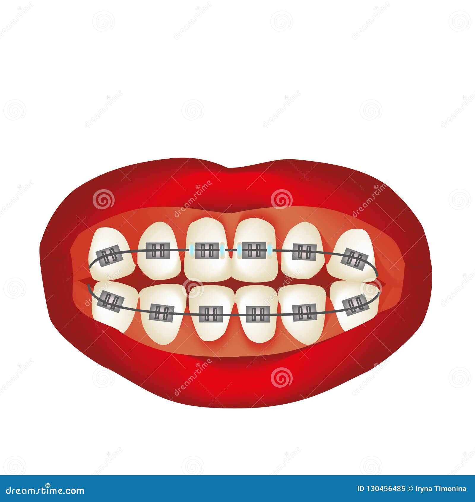 Braces on the Teeth. Infographics. Vector Illustration on Isolated