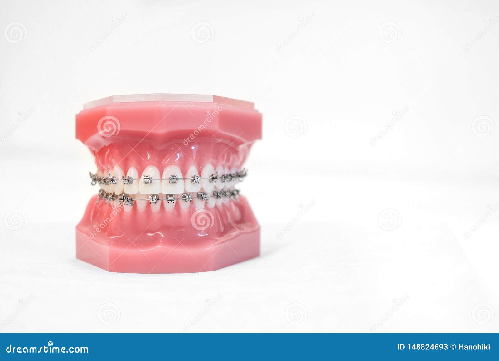 Braces on Teeth Model of Orthodontic Bracket or Brace Stock Image