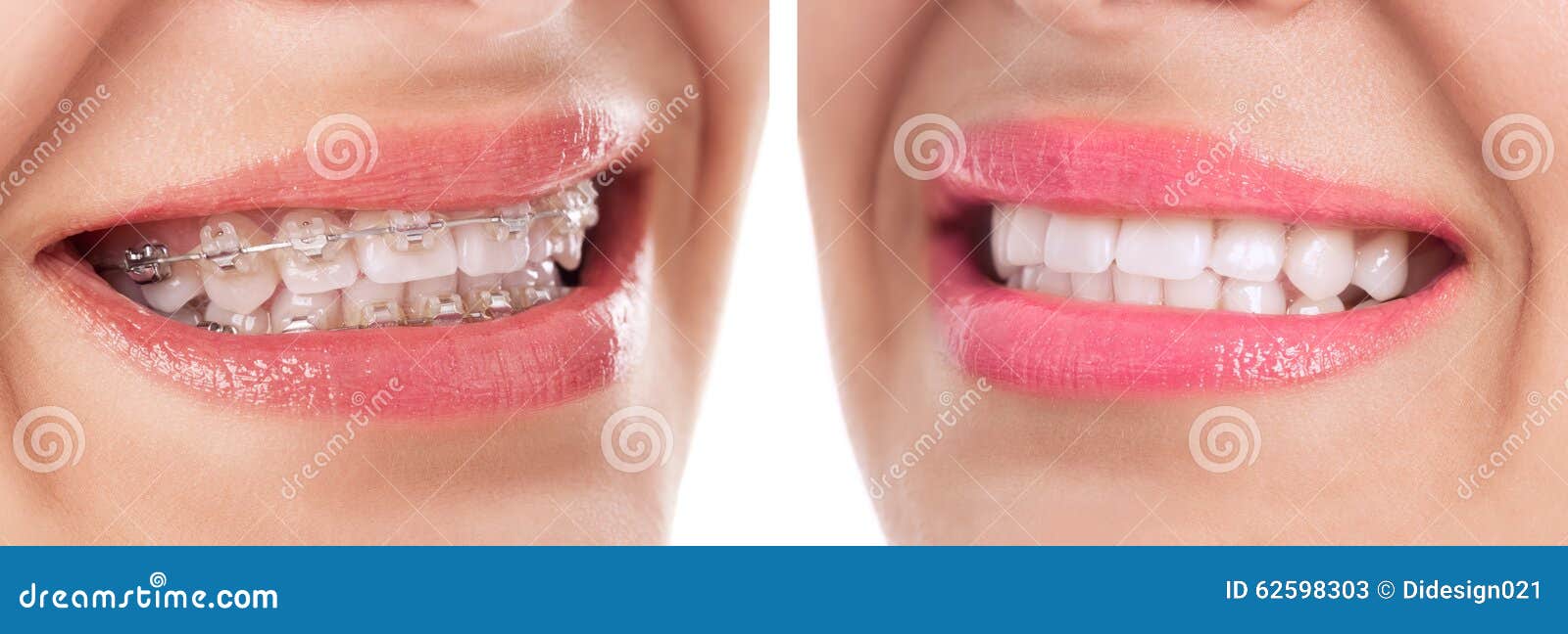Before and after Braces Treatment Stock Image Image of open, braces