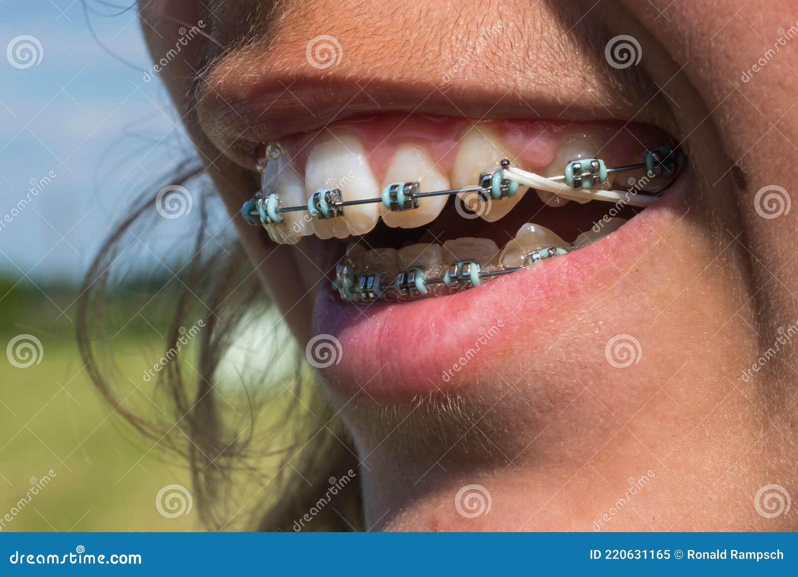 A brace in the mouth stock image. Image of hygiene, malocclusions