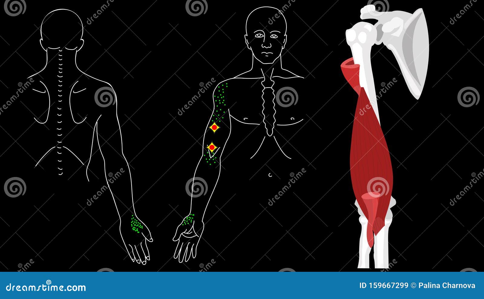 brachialis muscle. trigger points in the arm