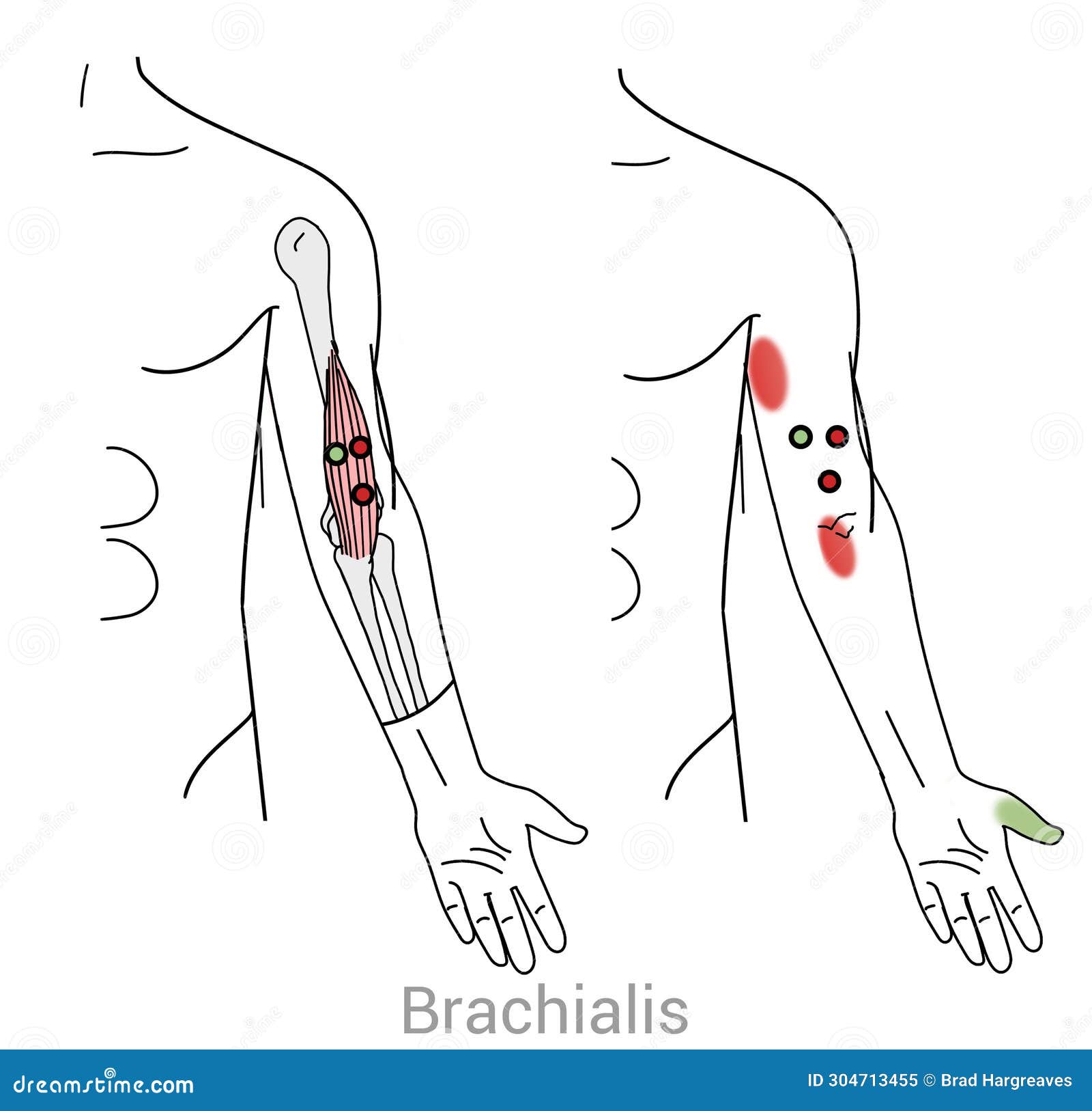 brachialis trigger points and upper arm pain