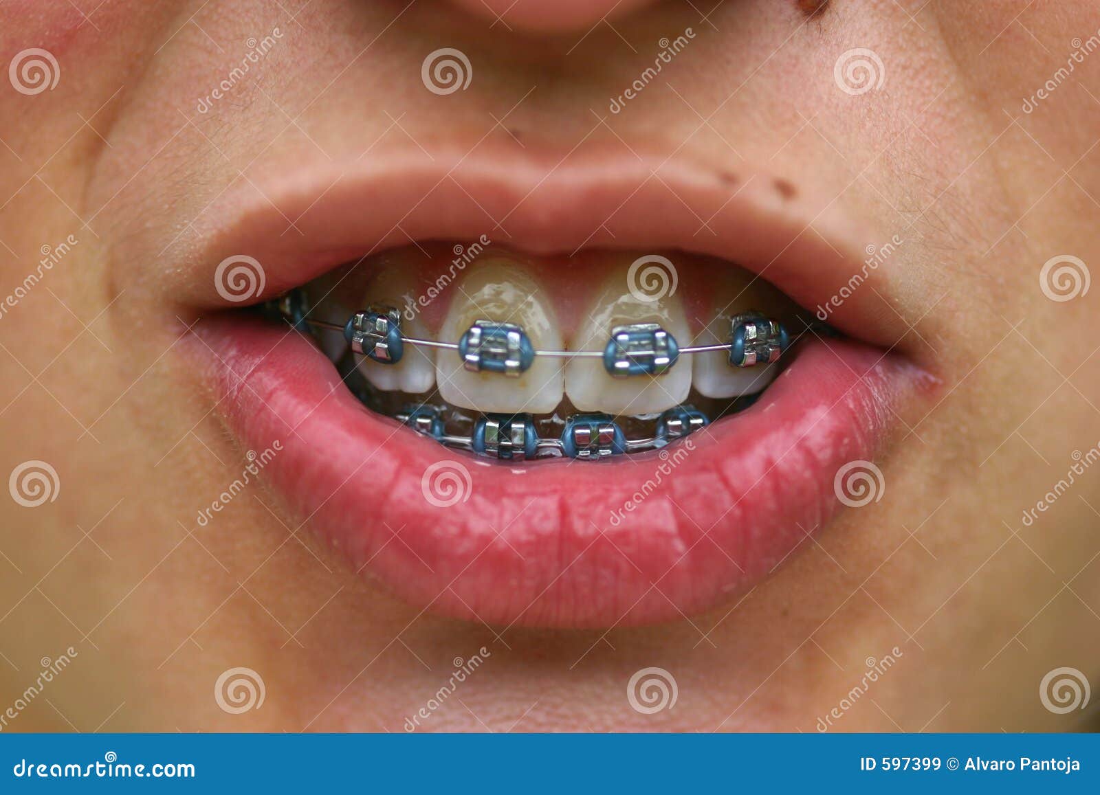 brackets