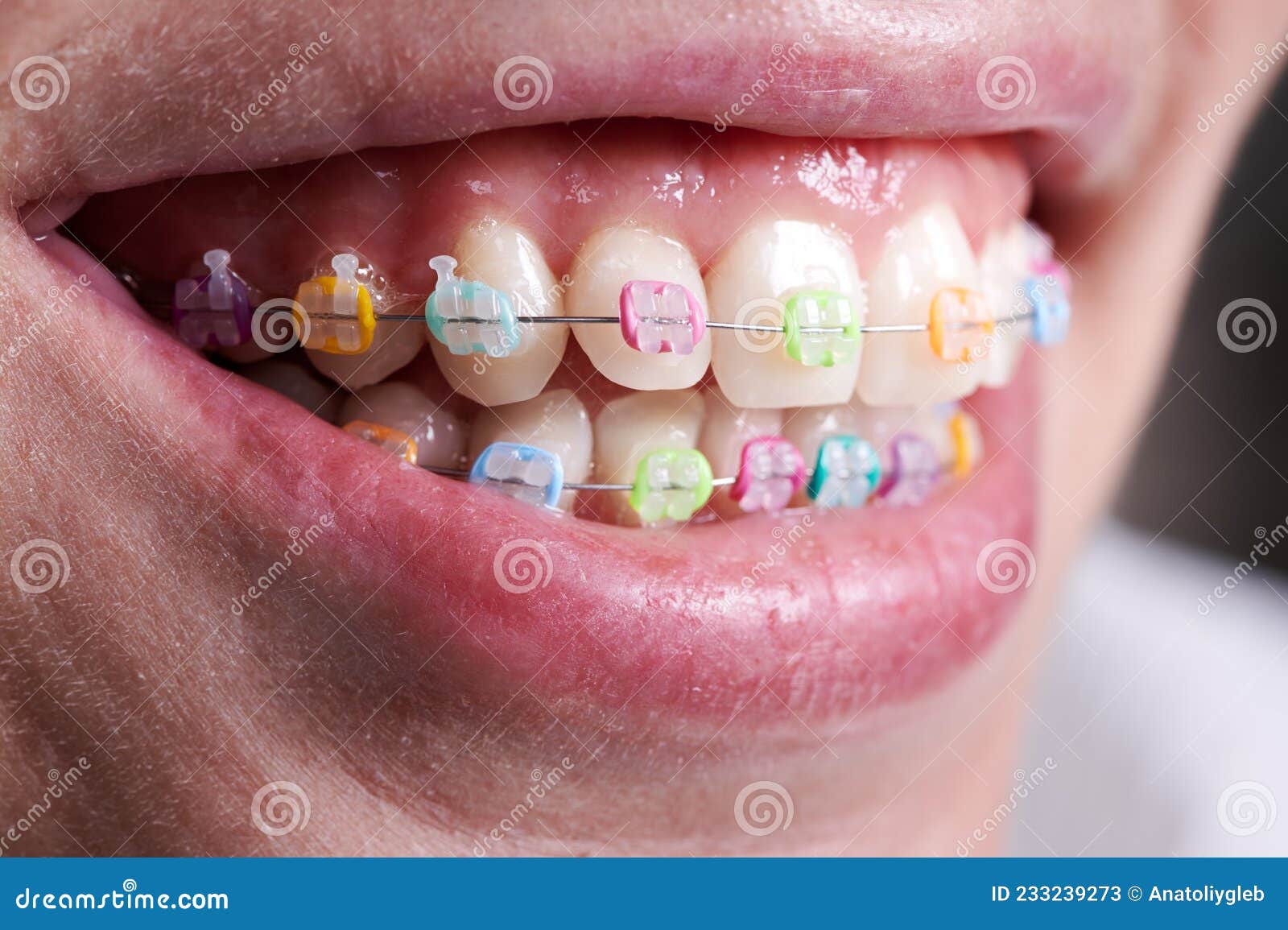 390+ Braces Rubber Bands Stock Photos, Pictures & Royalty-Free