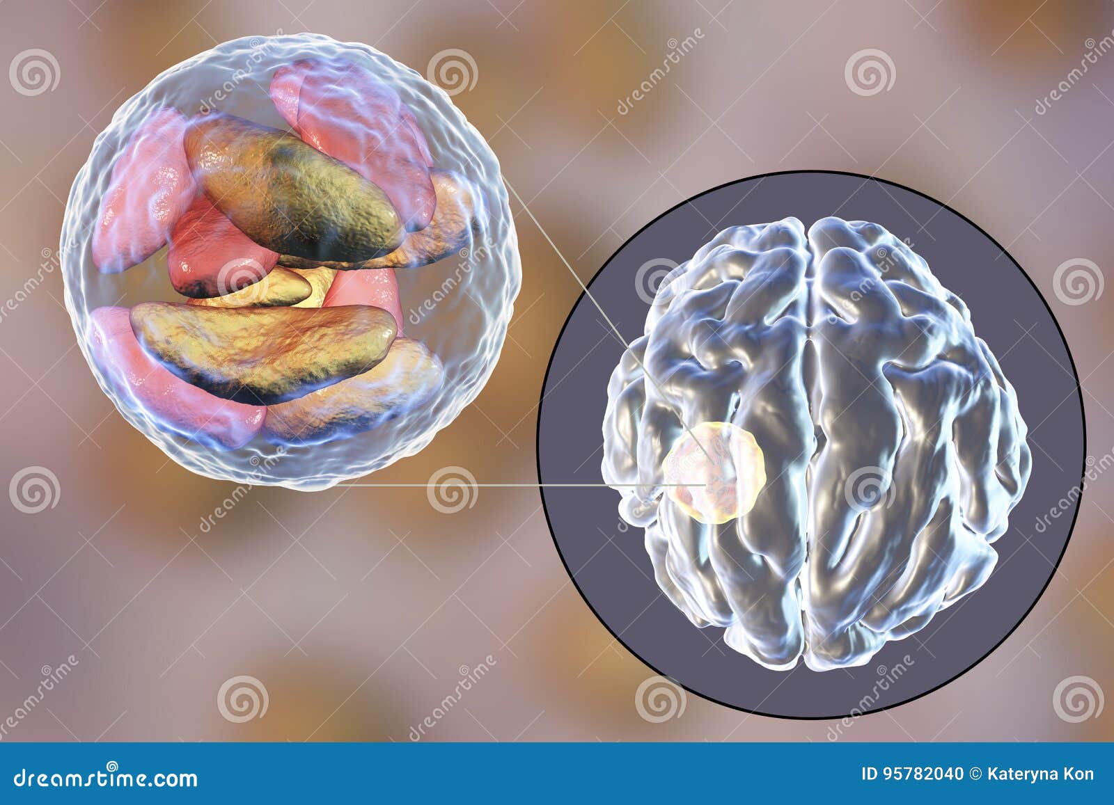 brain abscess caused by parasitic protozoan toxoplasma gondii