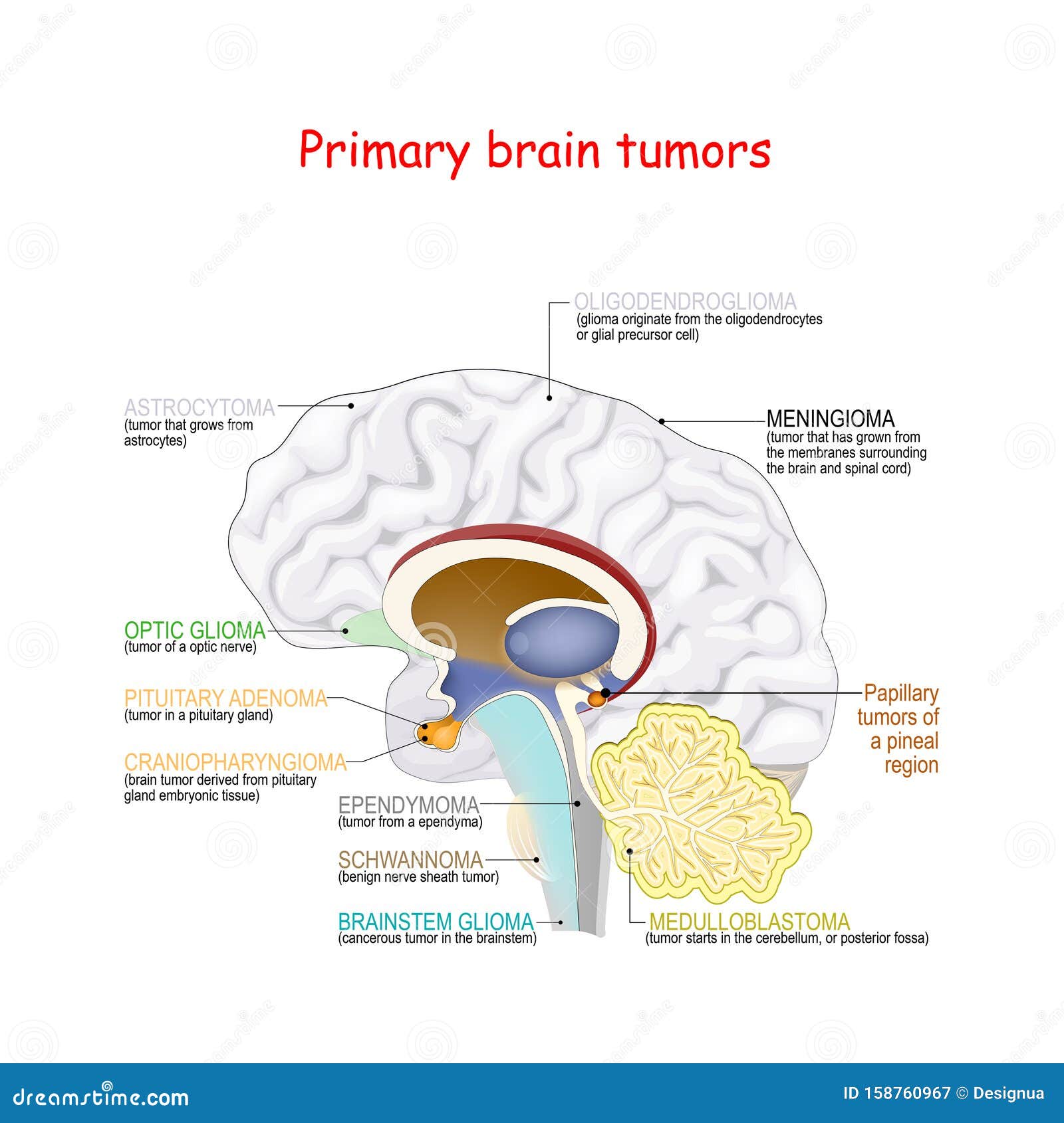 Different Types Of Brain Tumors
