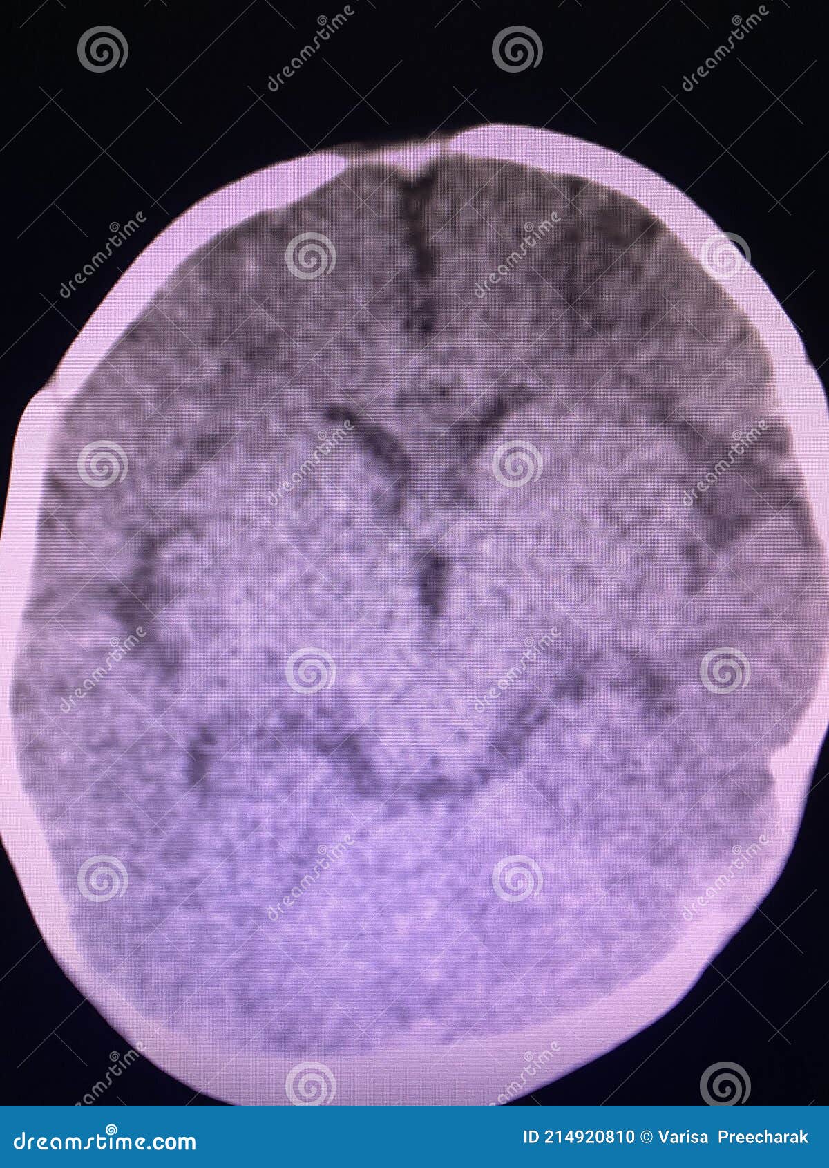 brain computed tomography
