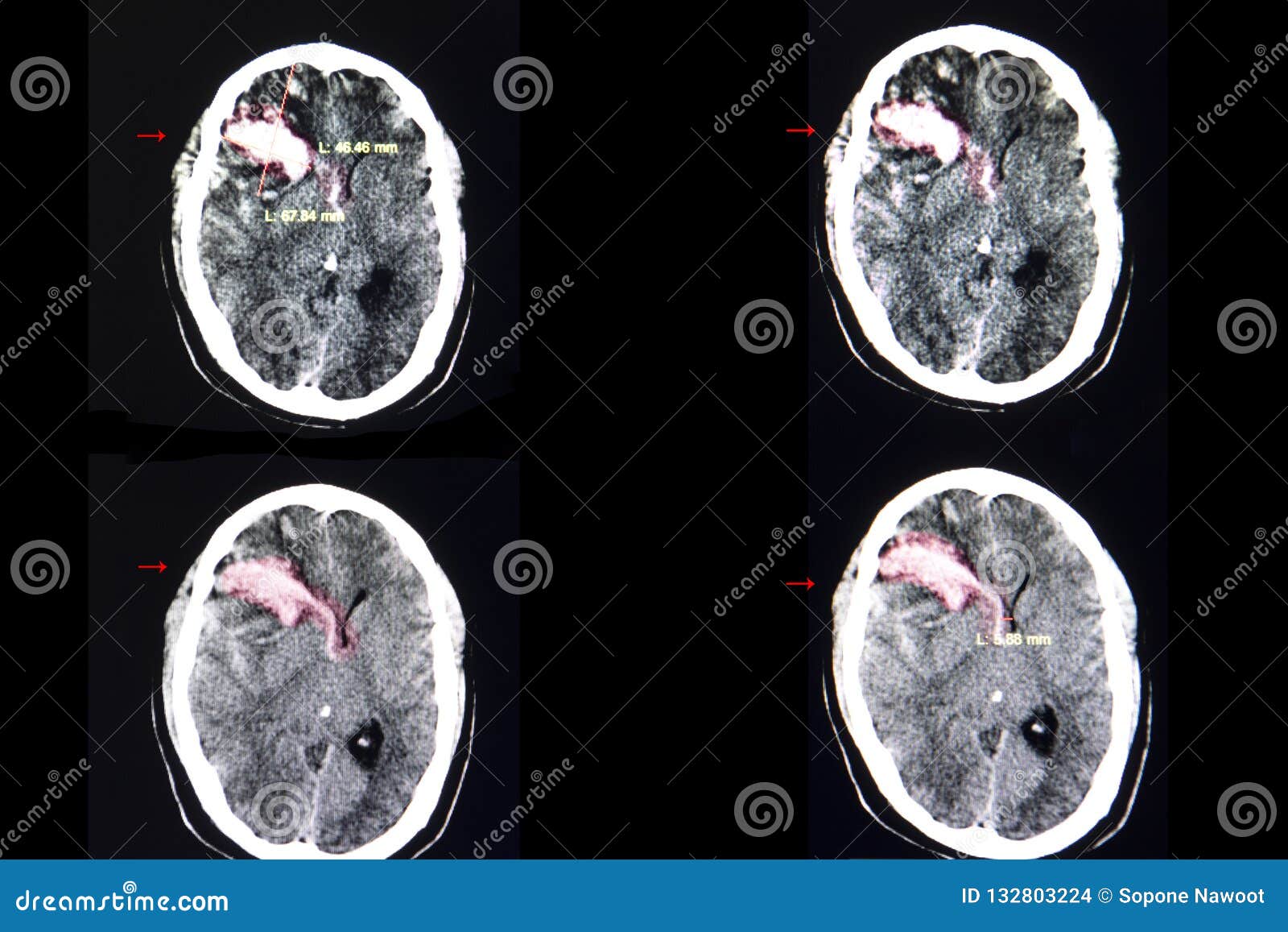 brain ct scan, intracerebral hemorrhage