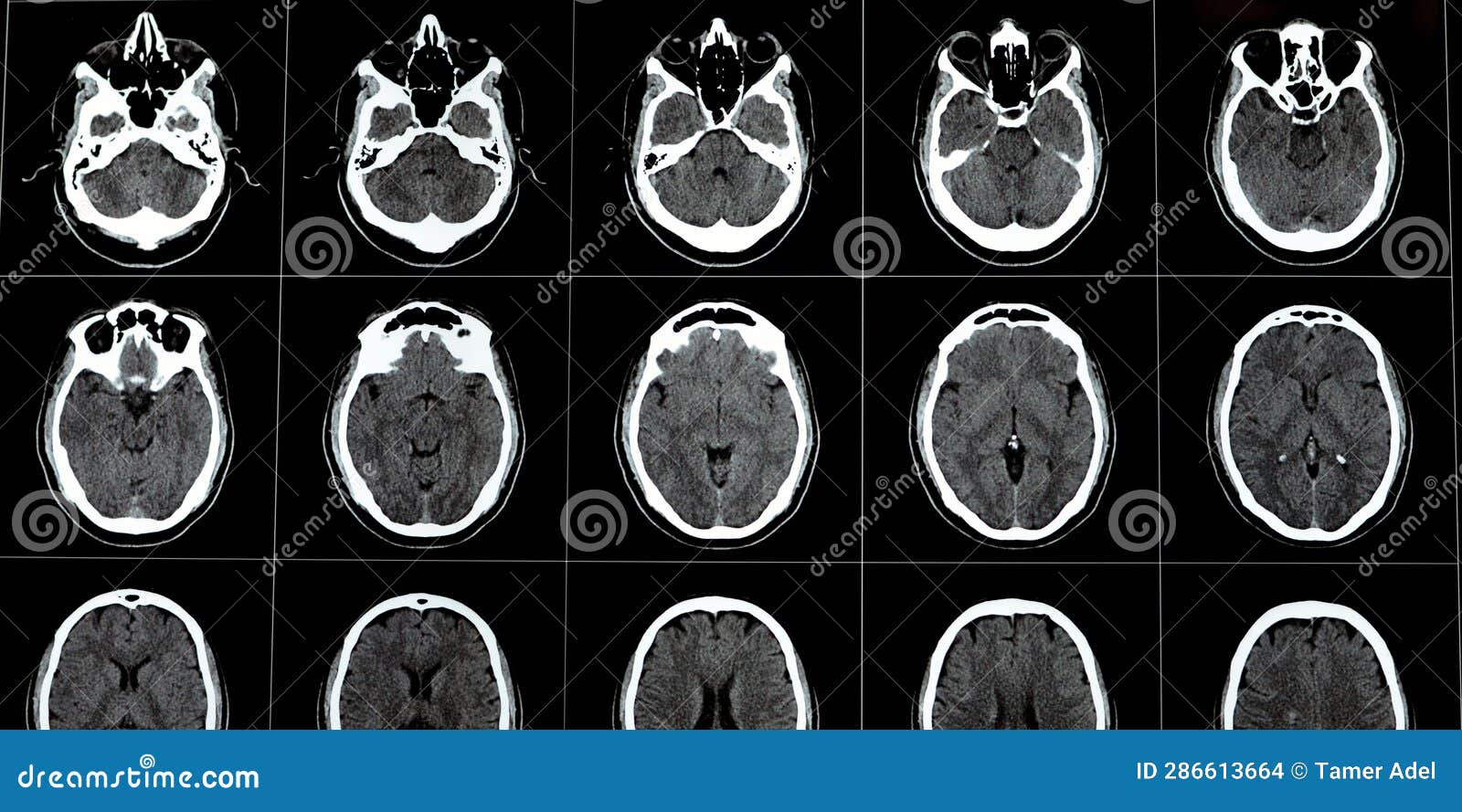brain ct scan showing brainstem cavernoma, right centrum semiovale developmental venous anomaly, intra cerebral haematoma, faint