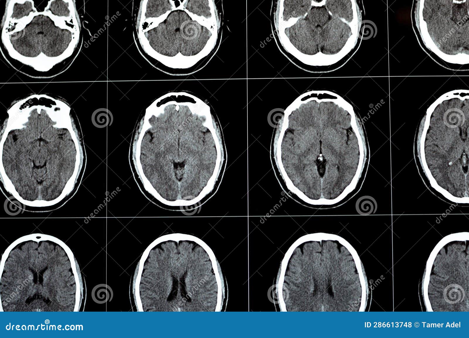brain ct scan showing brainstem cavernoma, right centrum semiovale developmental venous anomaly, intra cerebral haematoma, faint