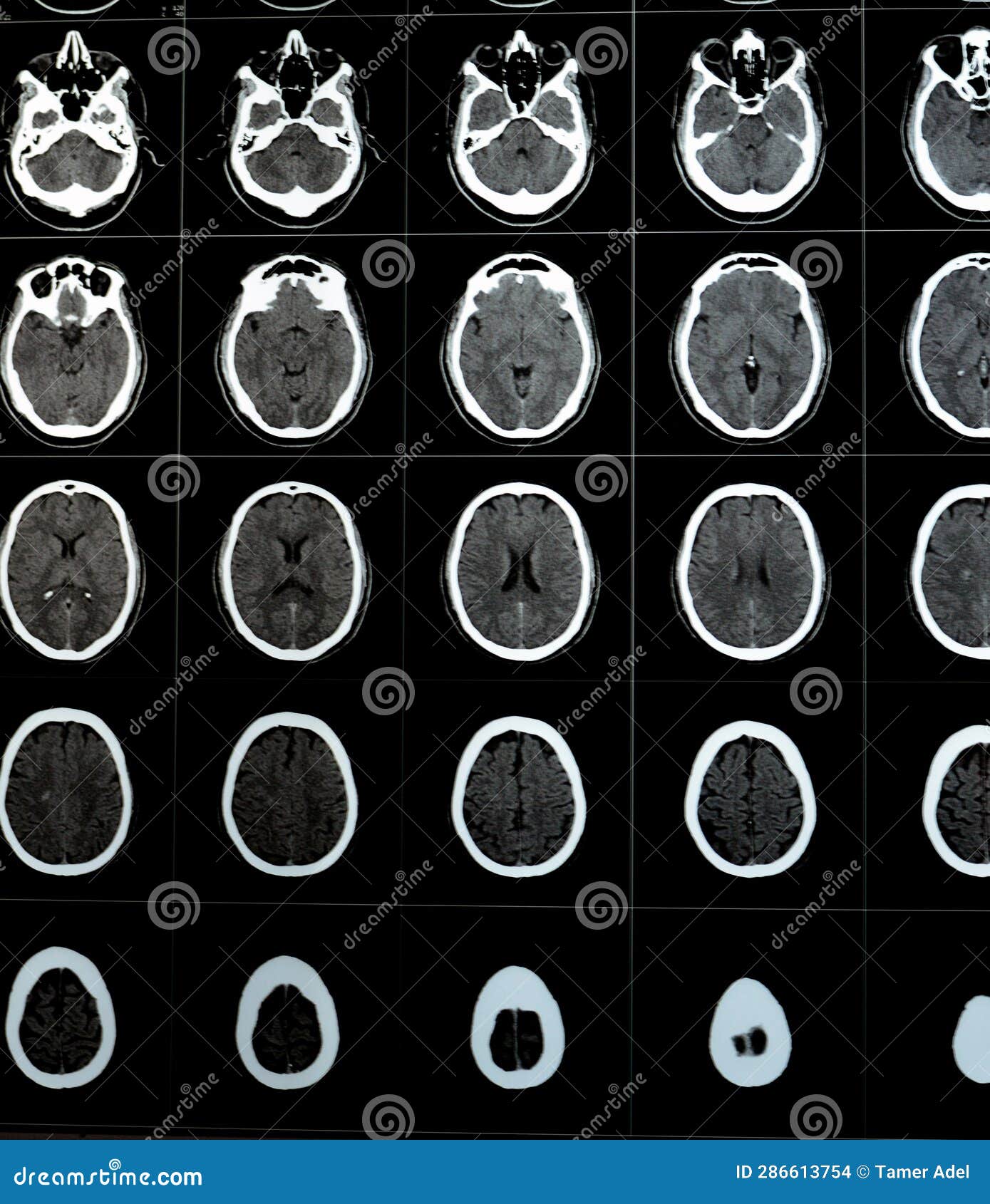 brain ct scan showing brainstem cavernoma, right centrum semiovale developmental venous anomaly, intra cerebral haematoma, faint