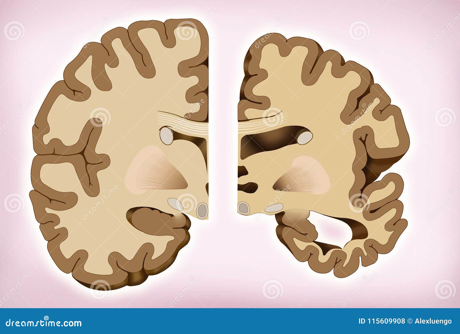 brain difference in alzheimer`s, this  shows the comparison of two halves of the brain, one healthy half and the other