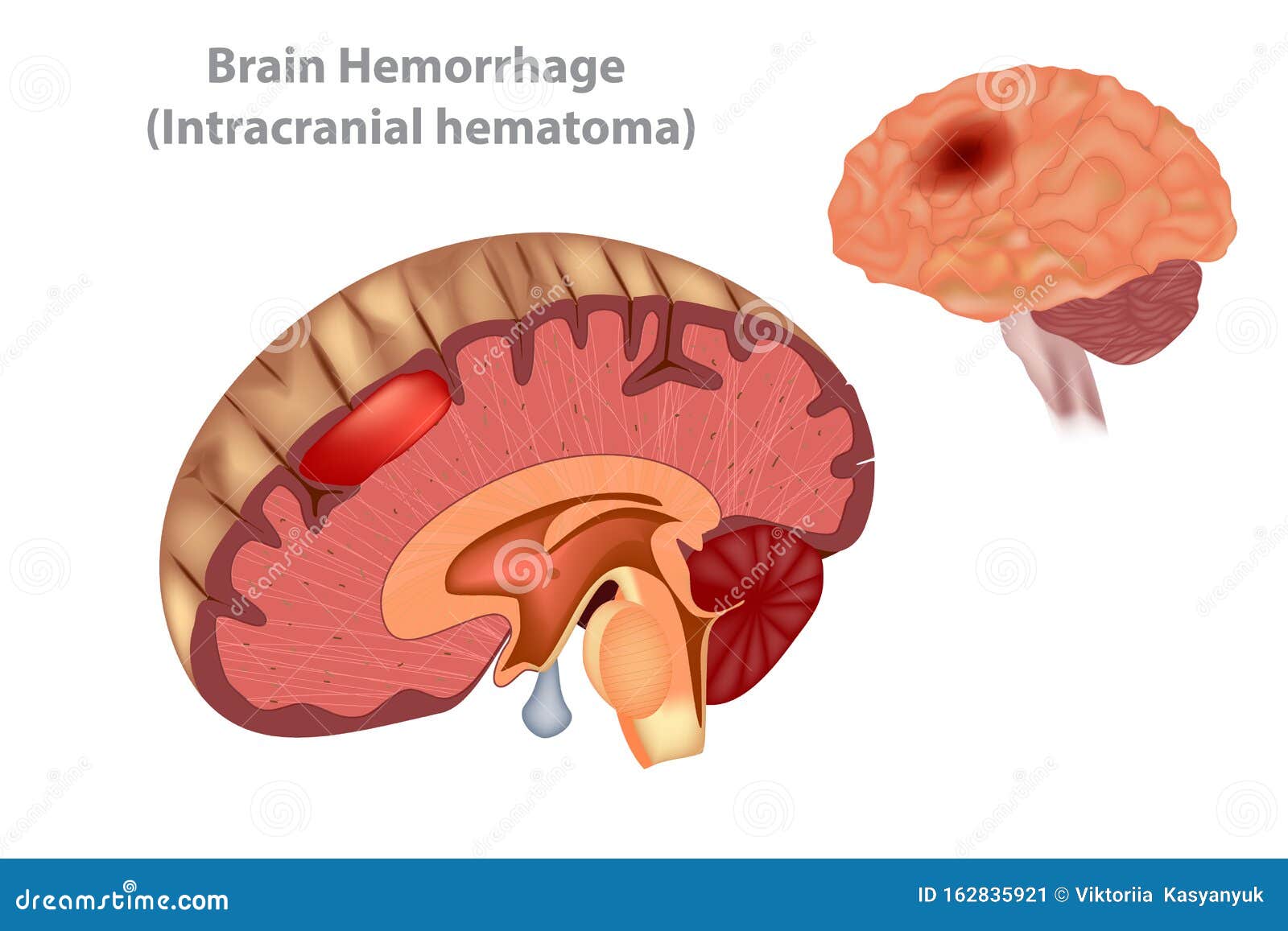 brain hemorrhage intracranial hematoma