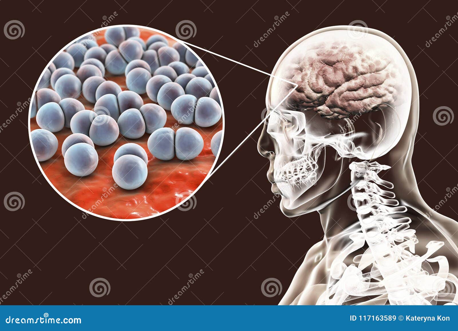 brain bacteria infection caused streptococcus pneumoniae microbe