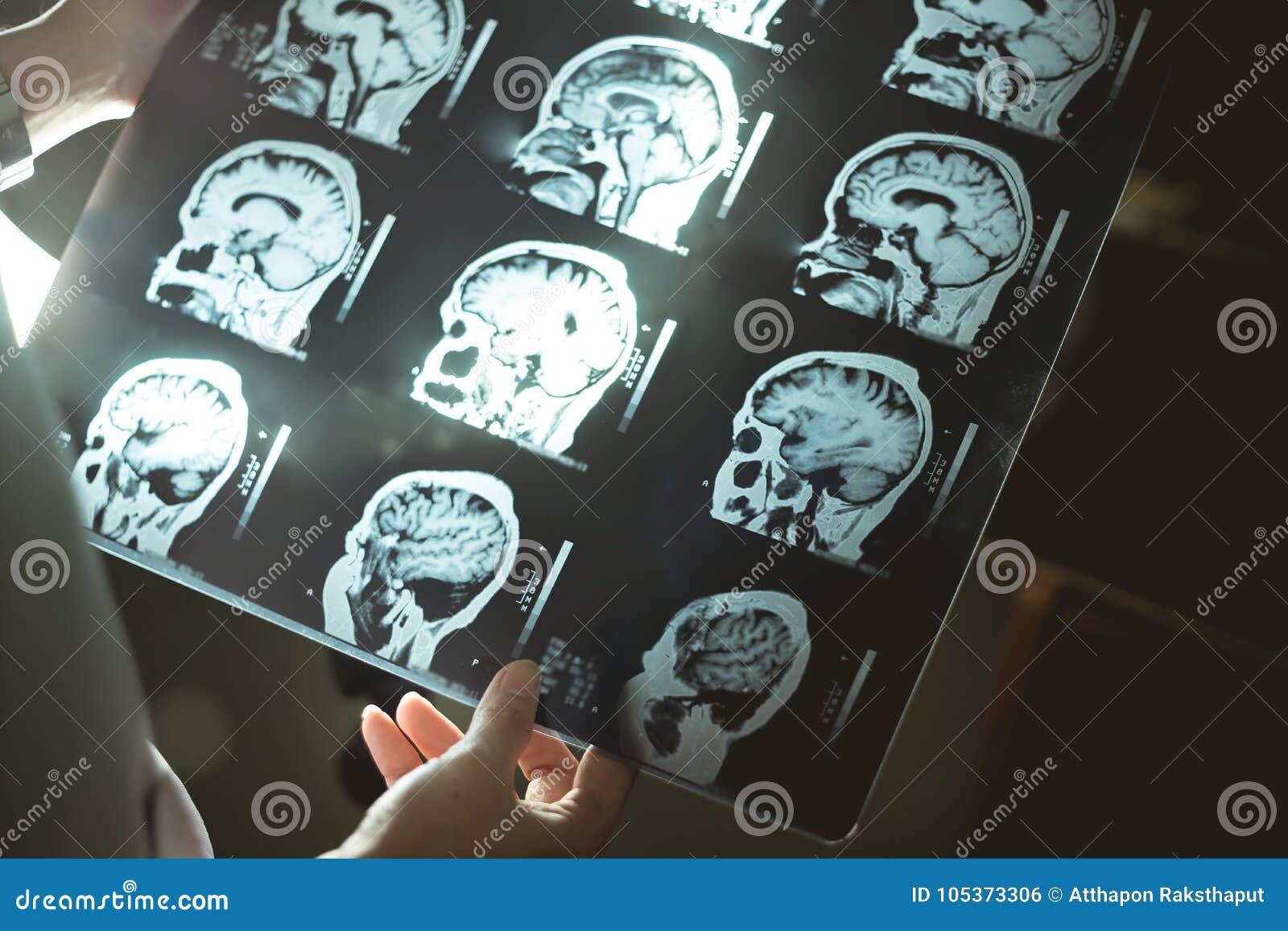 brain mri and dementia