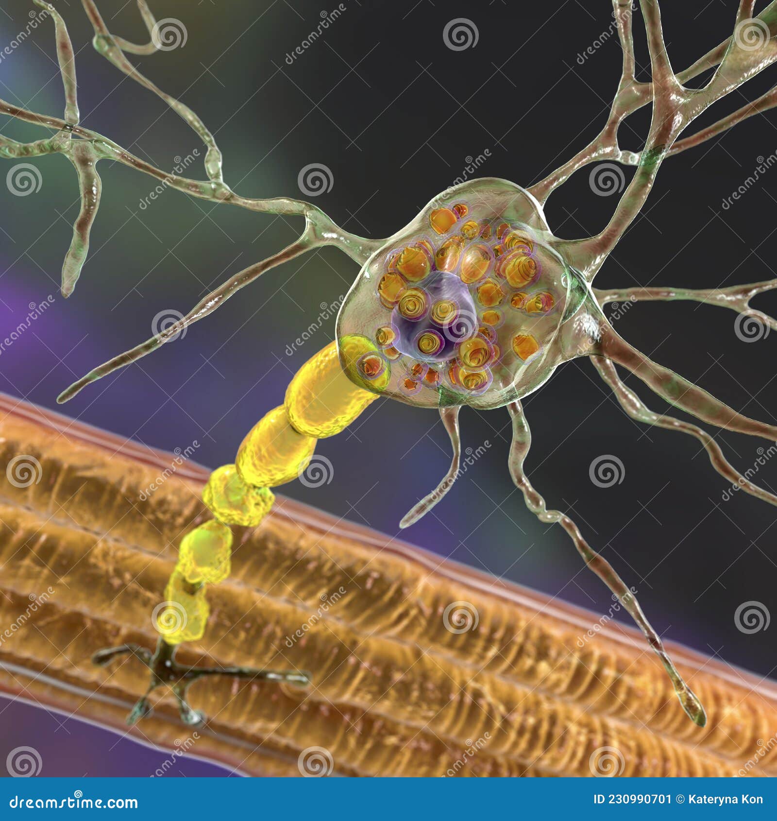 brain neurons in tay-sachs disease, 3d 