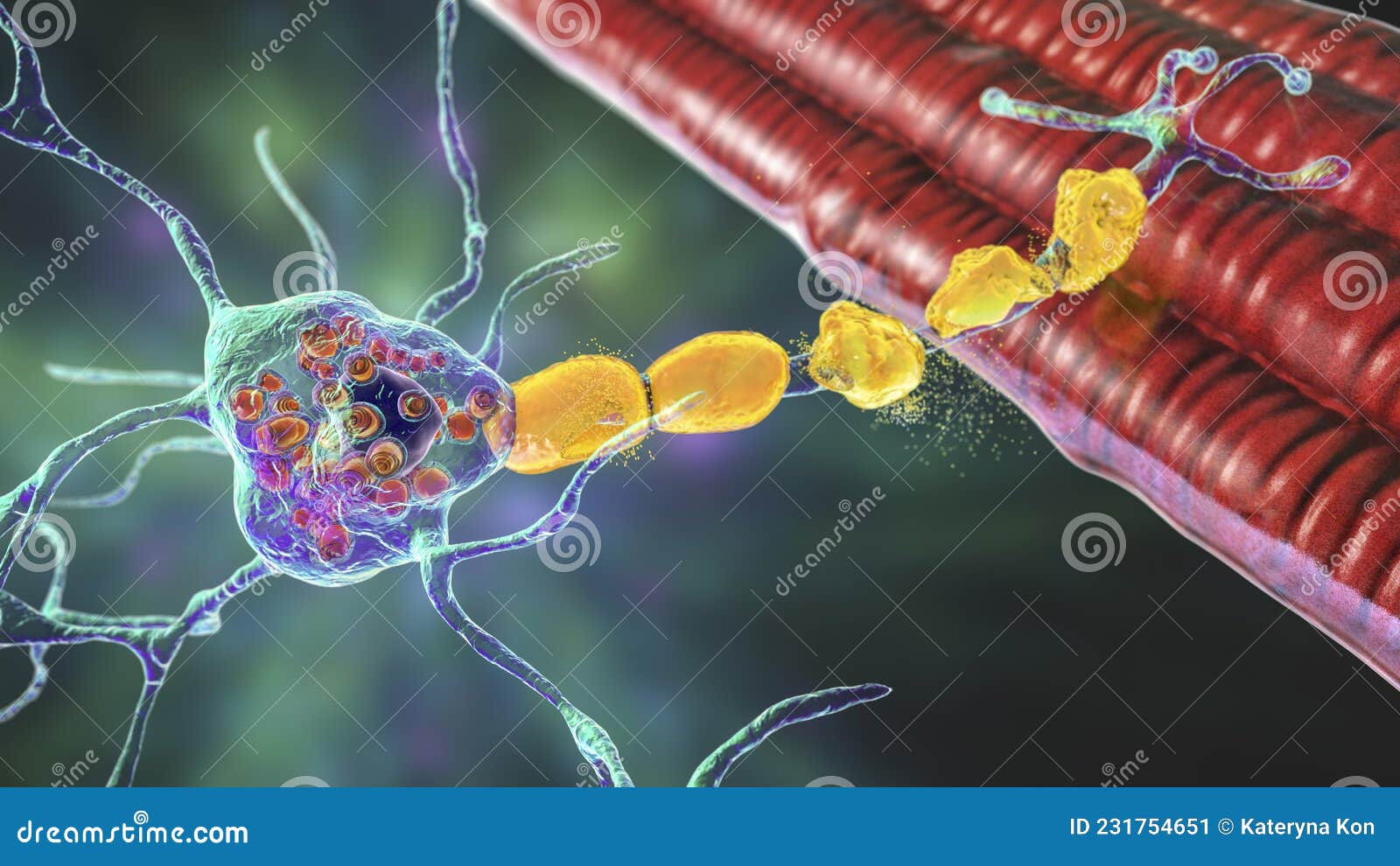 brain neurons in tay-sachs disease, 3d 