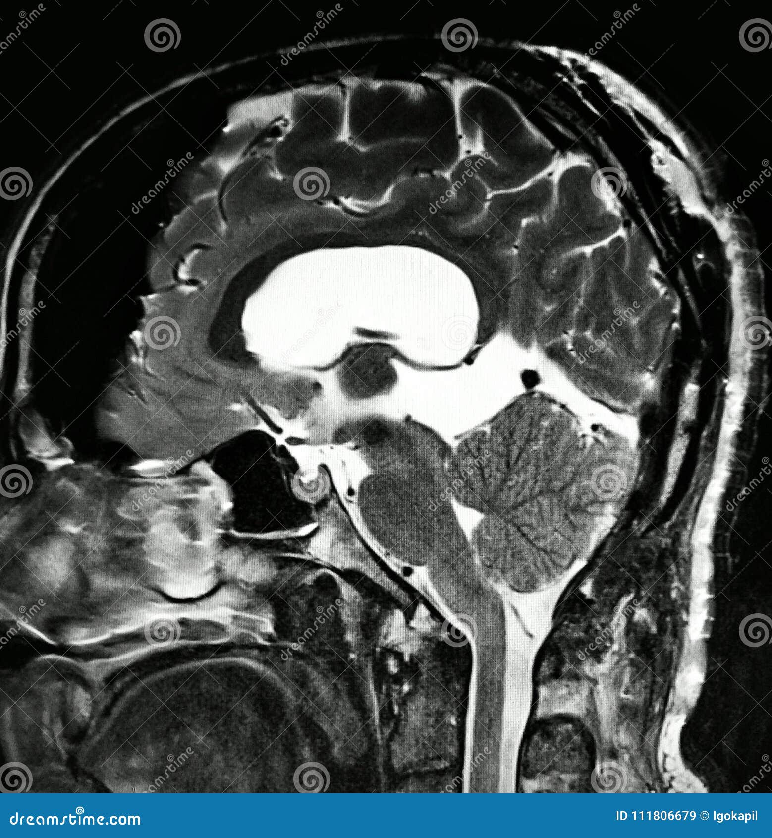 Brain Pathology Pineal Cyst Mri Exam Stock Illustration - Illustration ...