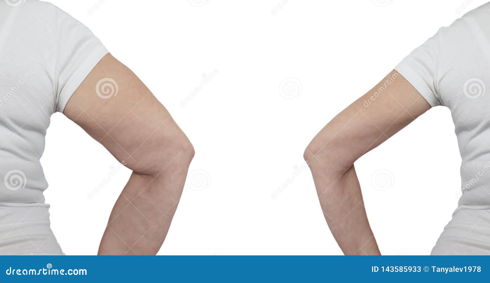 Braço Da Mulher Antes E Depois Da Perda De Peso Imagem de Stock