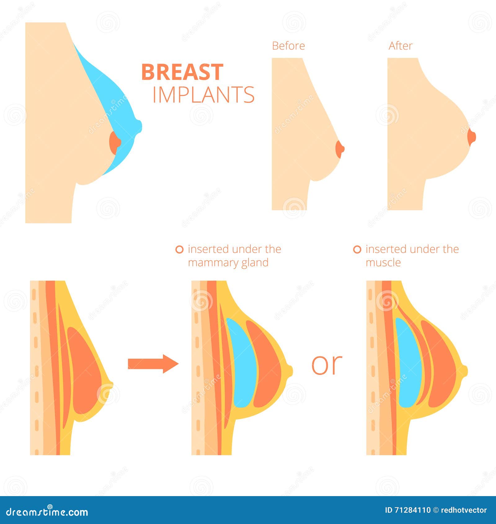 Breast Implant Chart