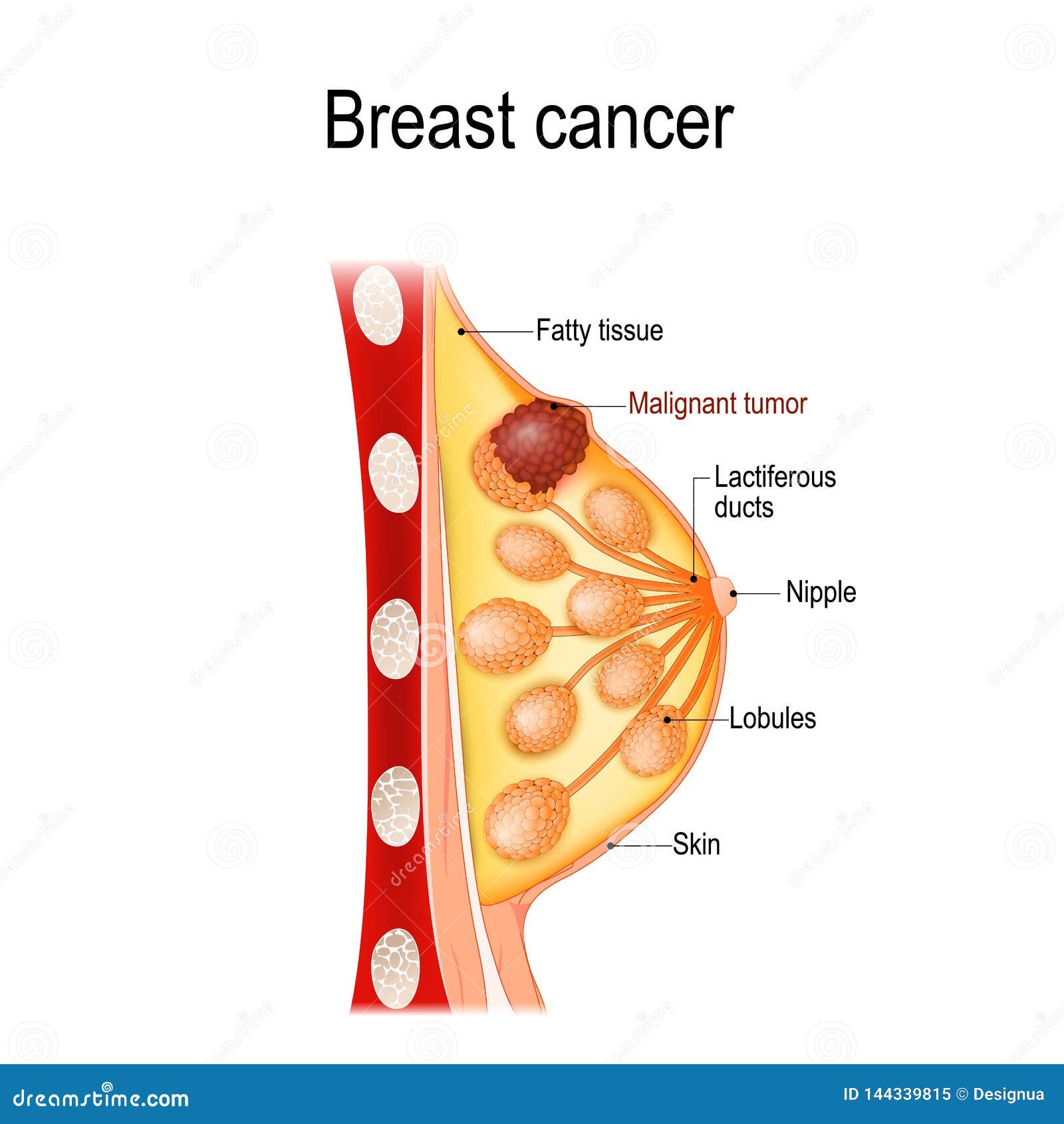 Breast Cancer. Cross-section of the Mammary Gland with Tumor Stock