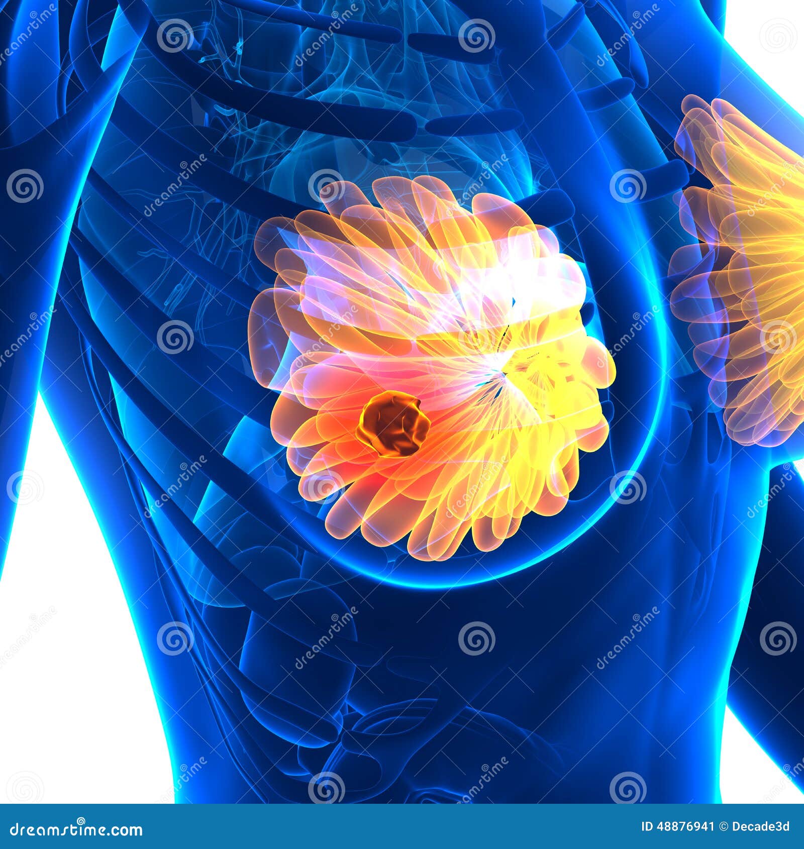 Breast Cancer - Female Anatomy - Isolated On White Stock Illustration