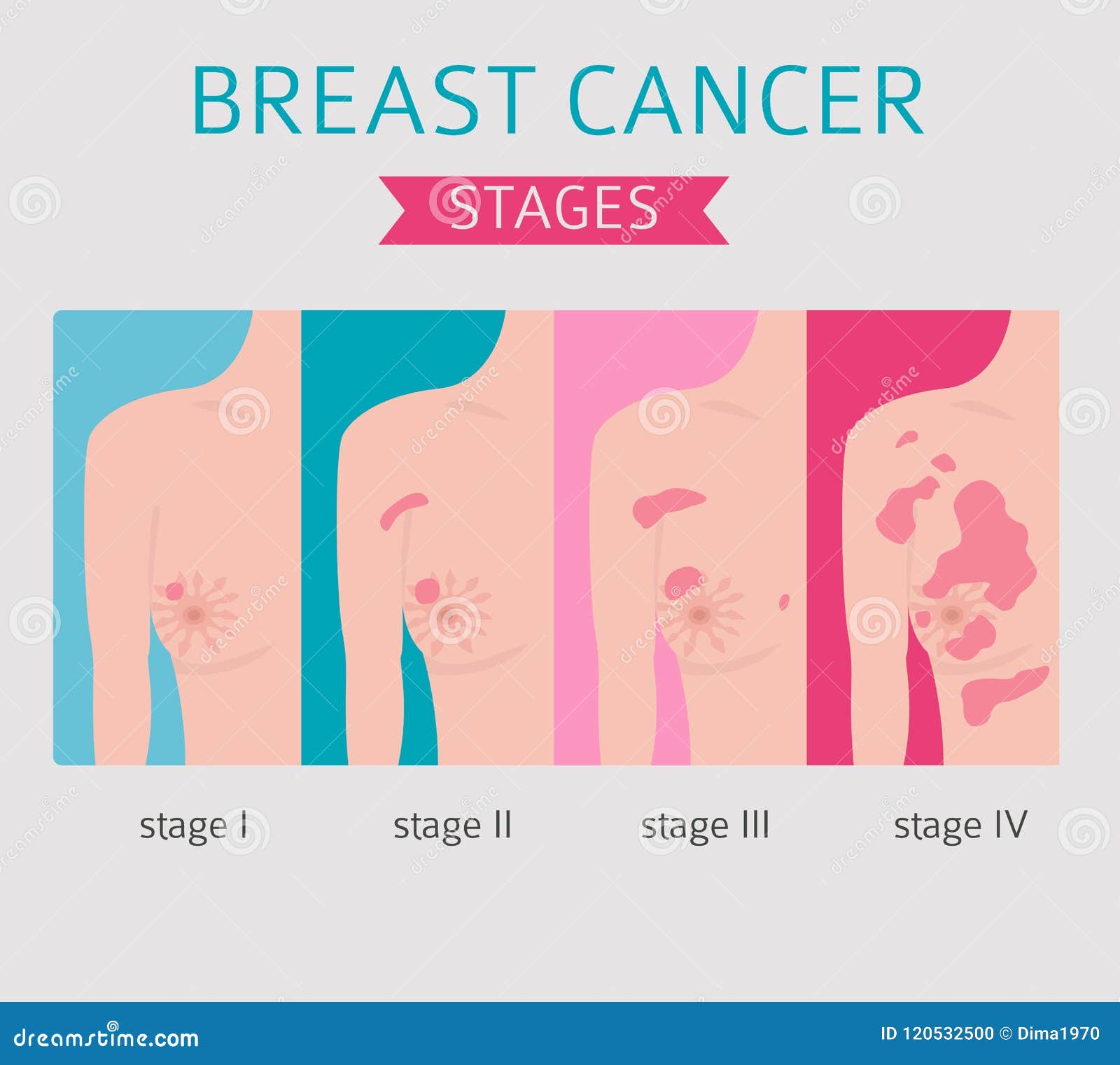 Breast Cancer, Medical Infographic. Diagnostics, Symptoms ...