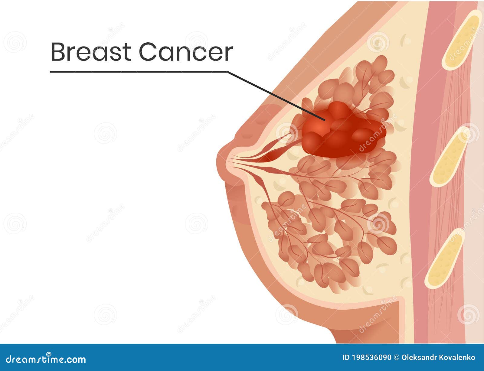 breast cancer structure.   of the lobular carcinoma