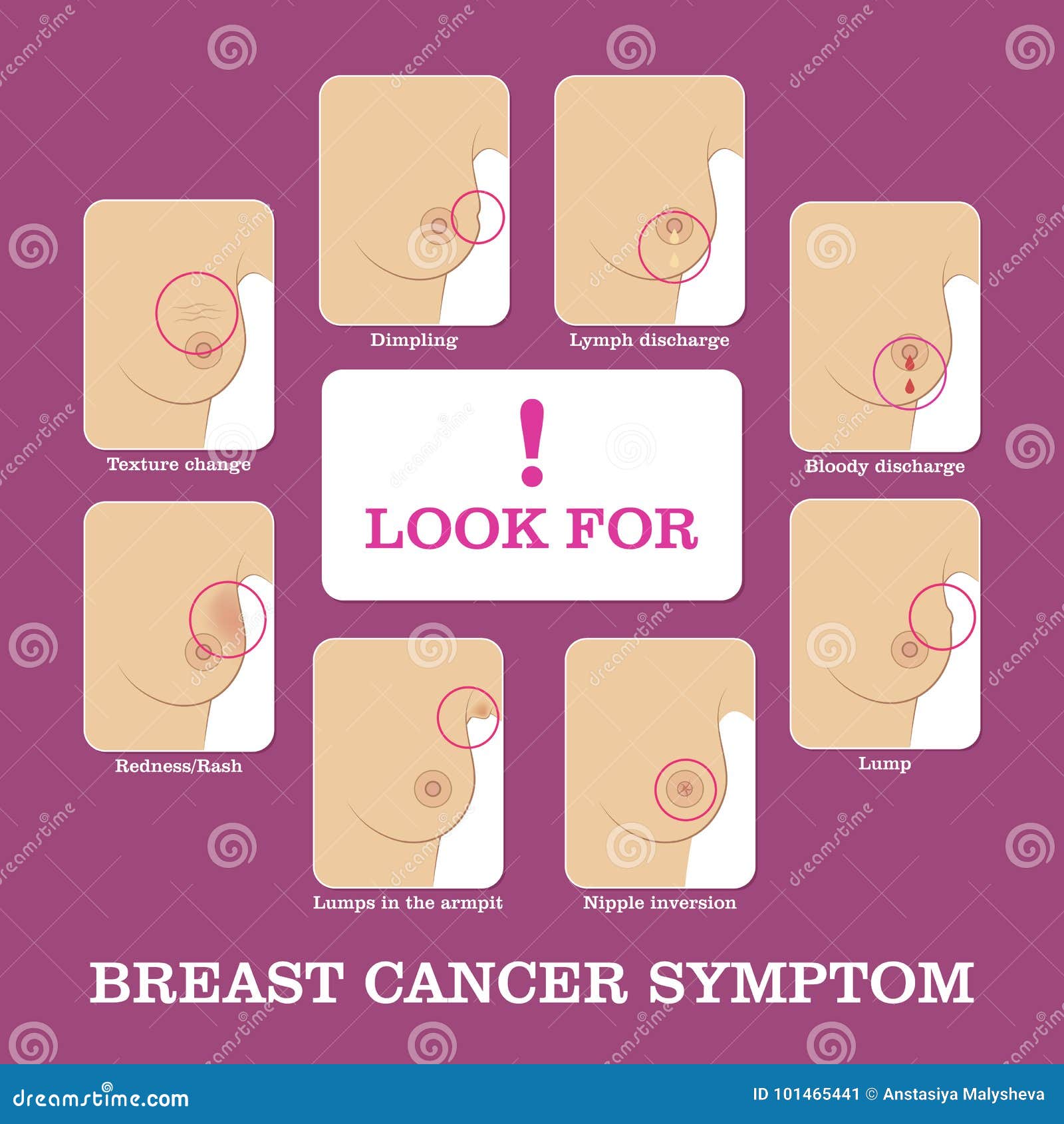 Breast Cancer Symptoms Infographic Stock Vector Illustration Of Looking Illness 101465441
