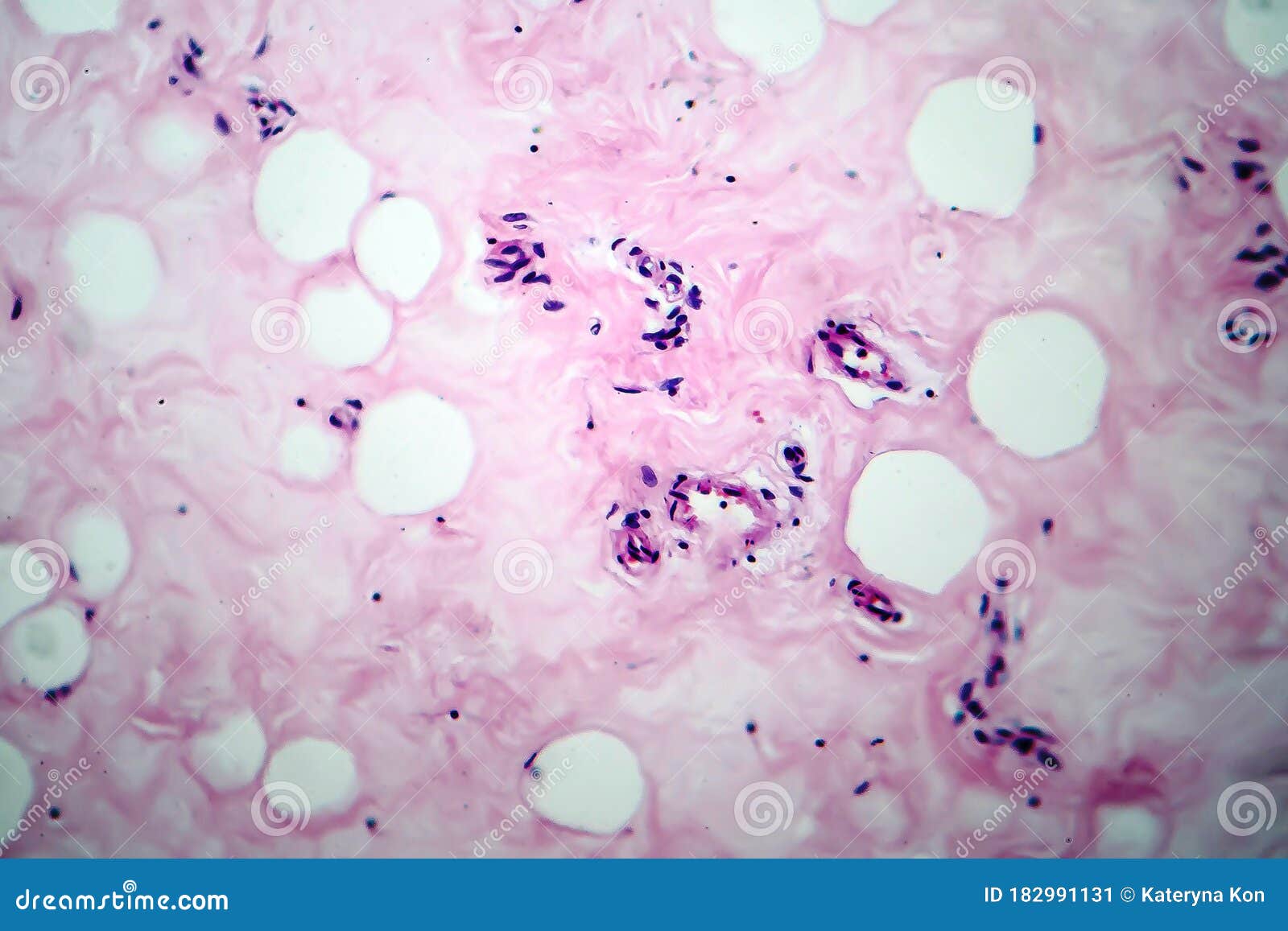 breast fibroadenosis, light micrograph